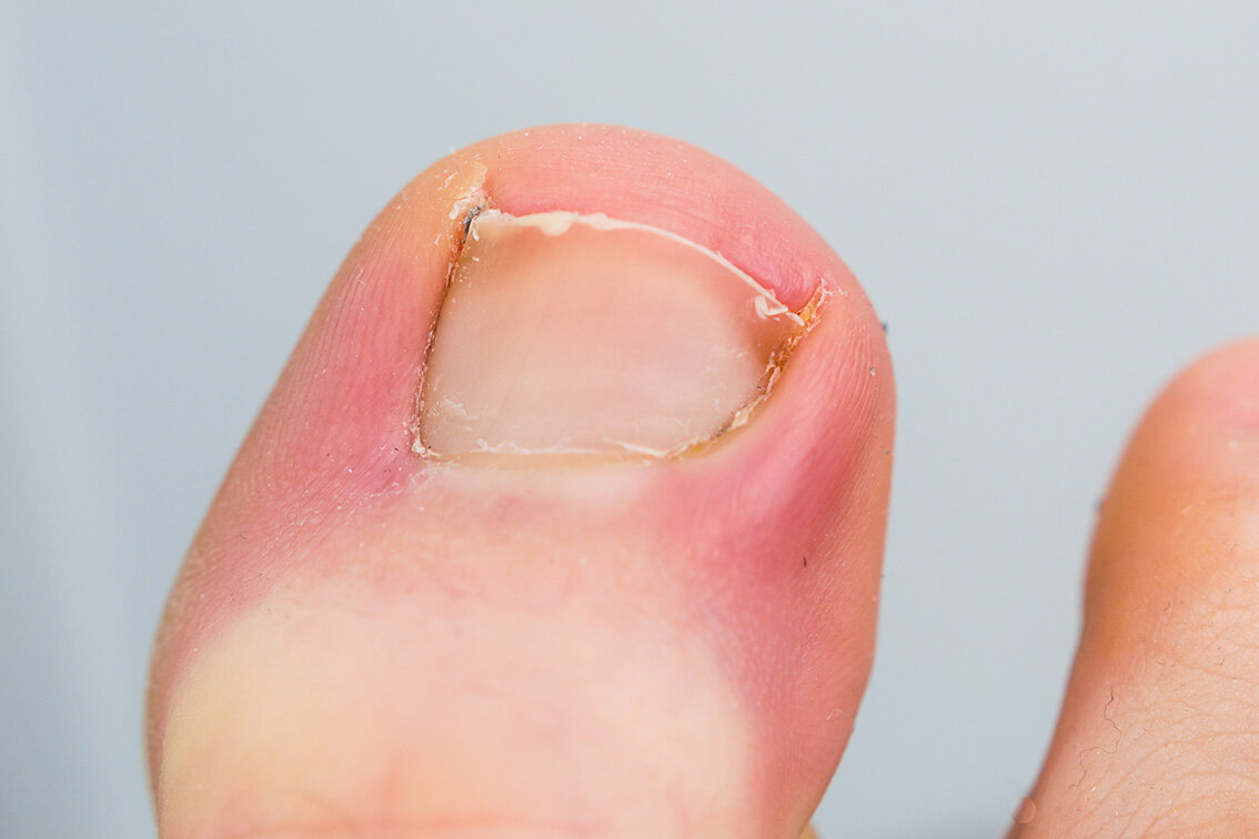 Toe Nail Removal Surgery Procedure - Toe Care