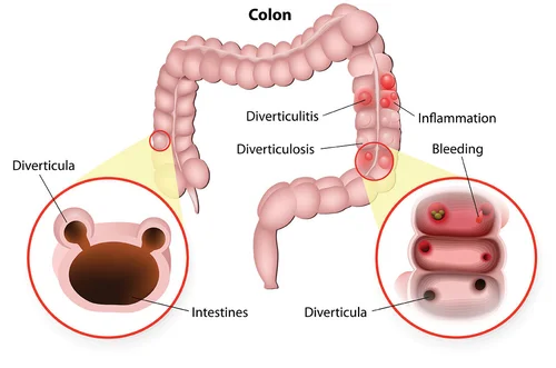 Diverticulitis Surgery Brisbane — Sunnybank Surgical Group | Brisbane ...