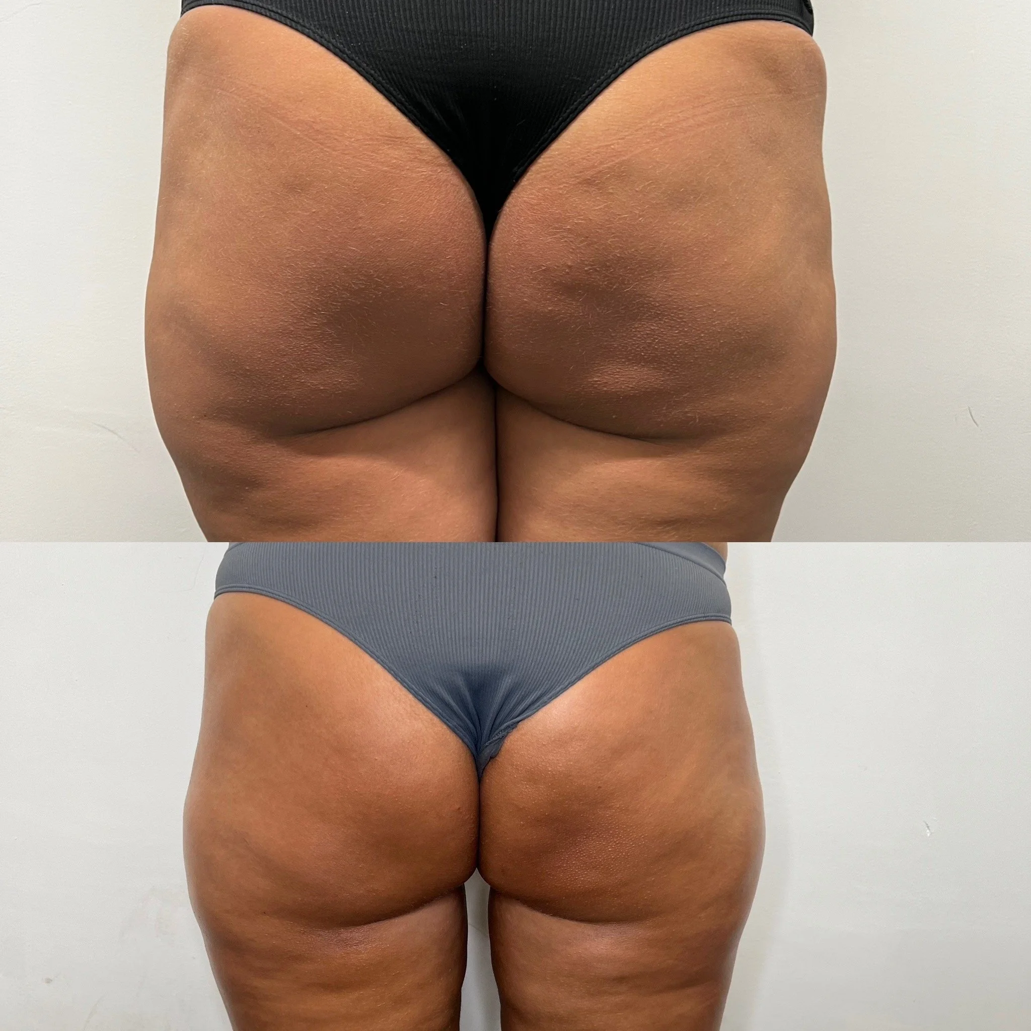 Skin tightening treatment Leeds