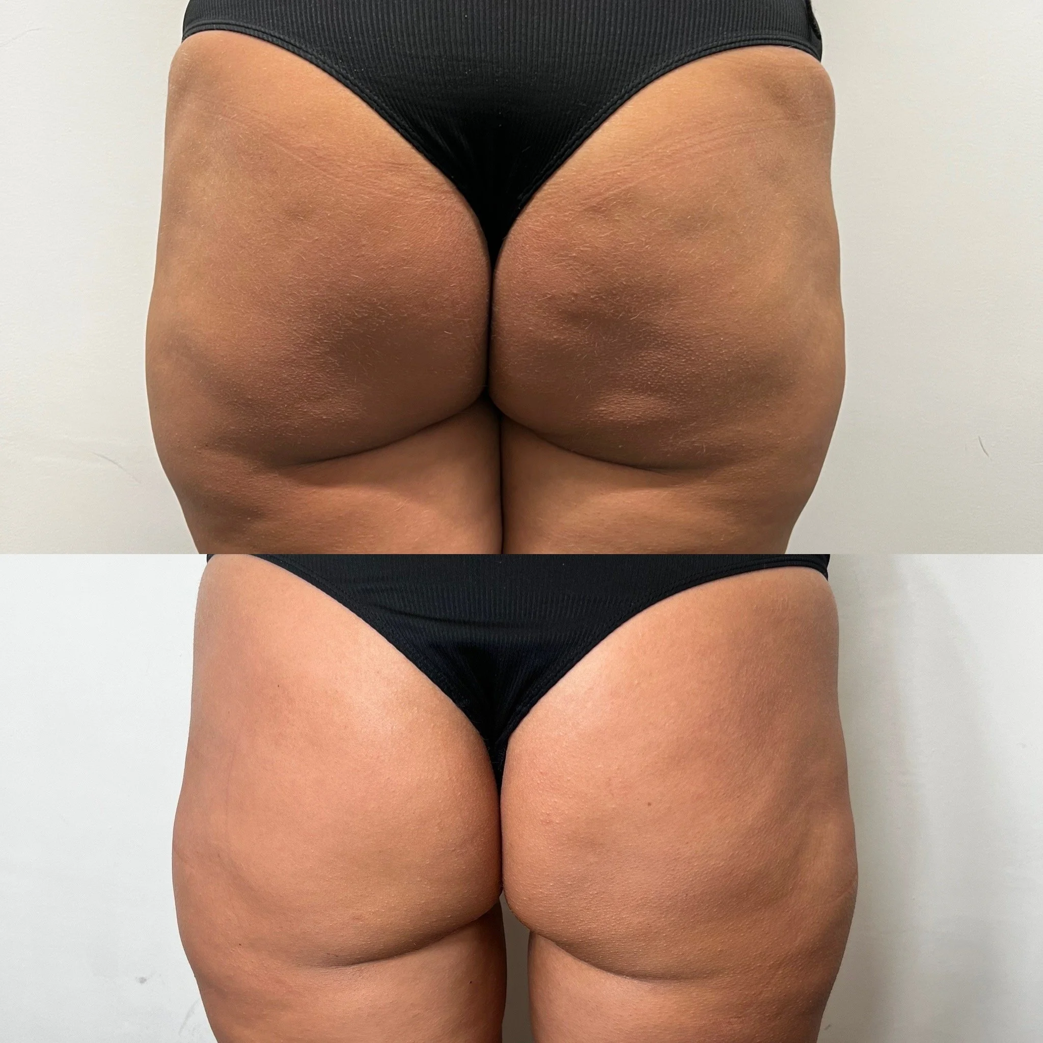 Side-by-side comparison of a person's buttocks before and after a cosmetic or skincare treatment, showing smoother skin and reduced dimpling in the after image.