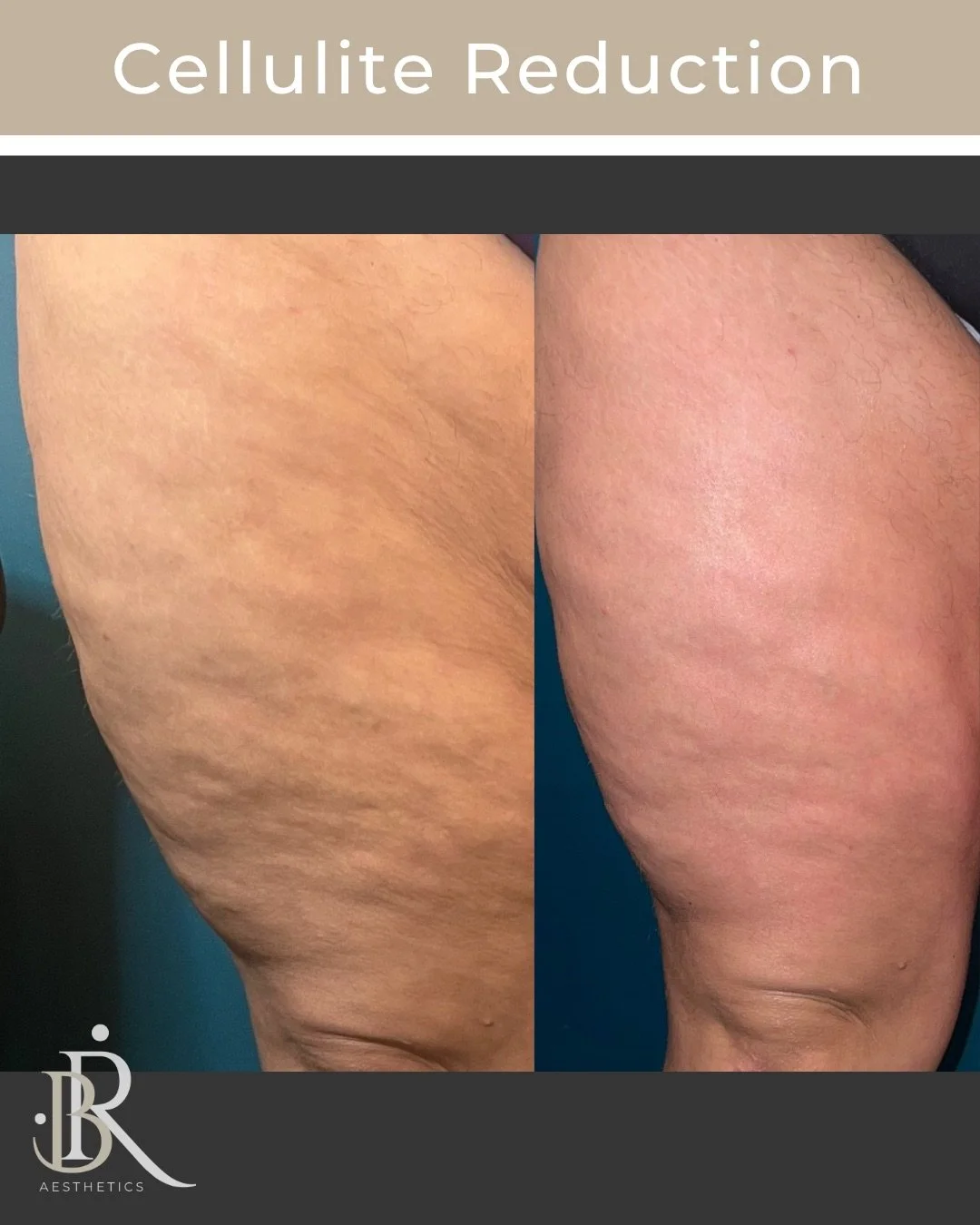 Side-by-side comparison of thighs showing reduction in cellulite and improved skin texture.