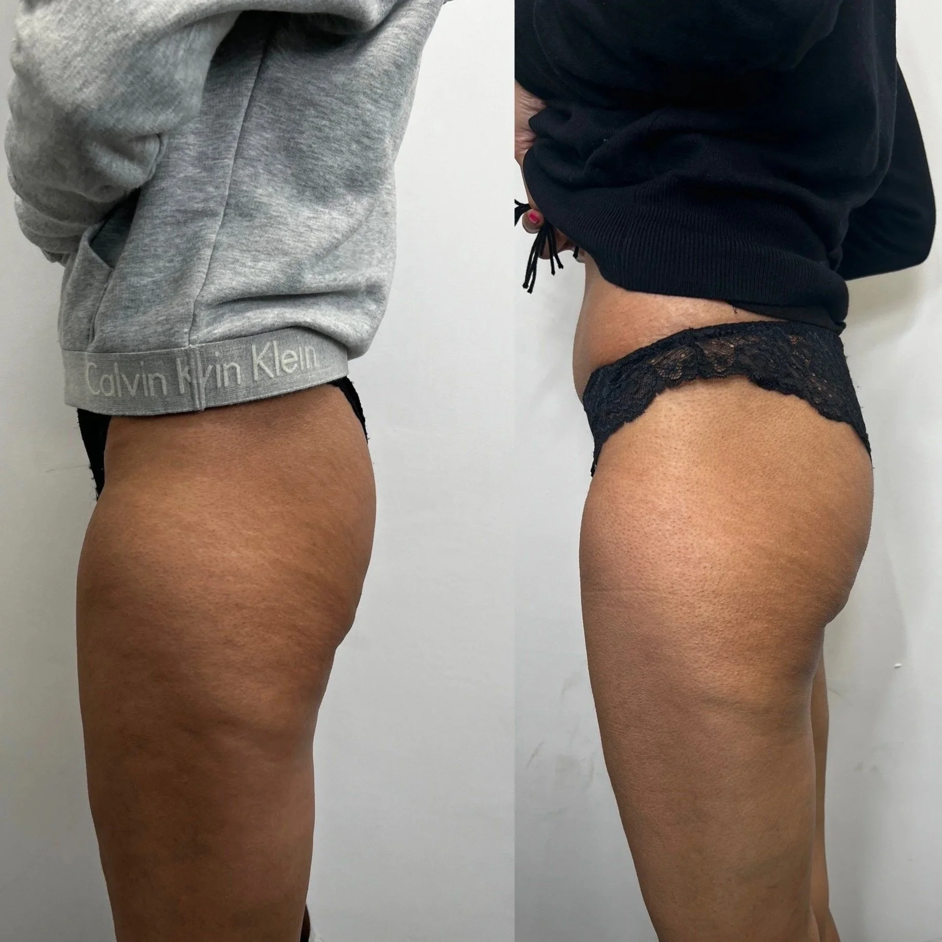 Side-by-side comparison photo of a person's lower body before and after a skin treatment, showing smoother skin texture on the right.