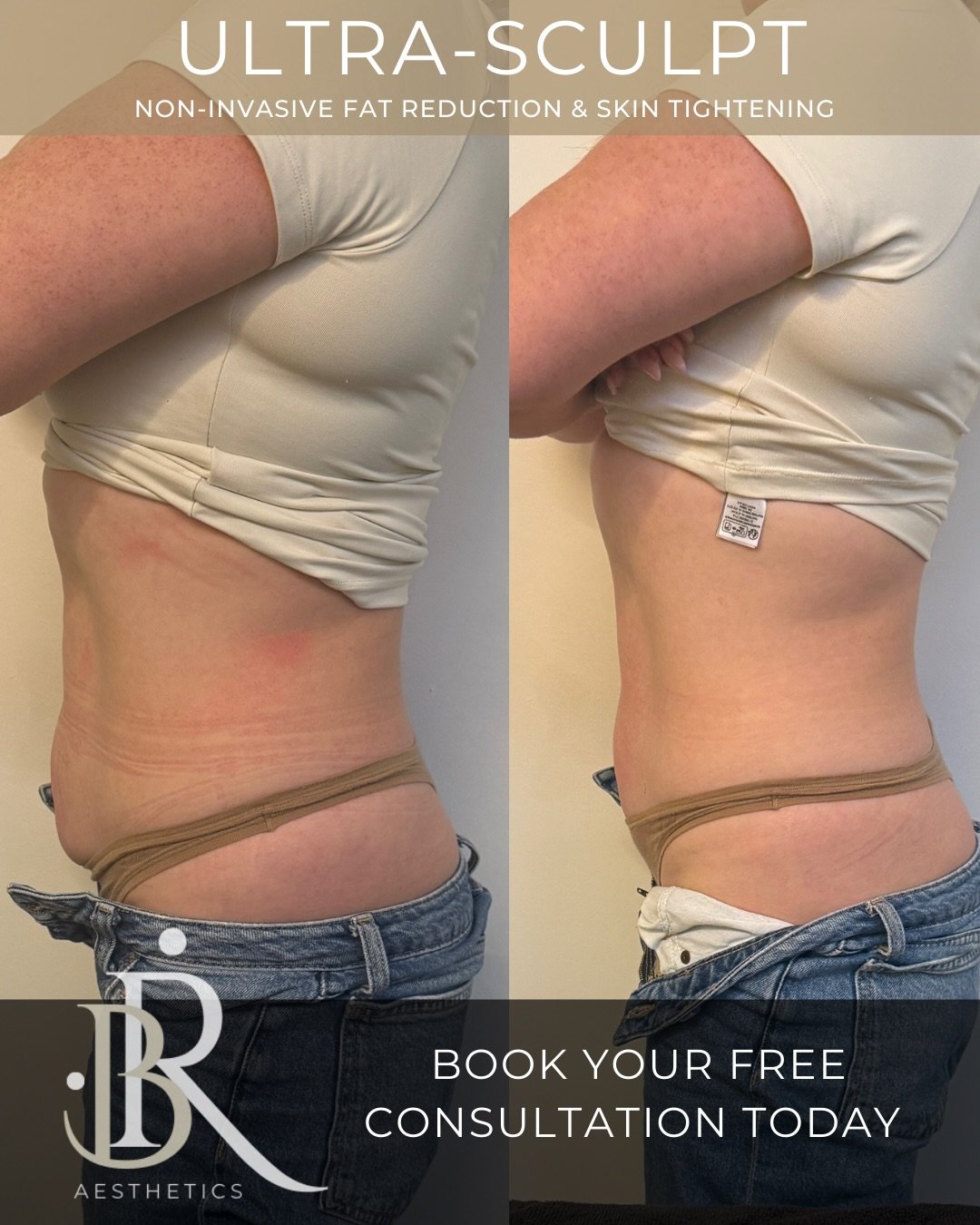 Ultra Sculpt &ndash; Treatment Description

Ultra Sculpt is a non-invasive body contouring treatment designed to target stubborn fat, tighten the skin, and enhance your natural shape&mdash;without needles, pain, or downtime.

This advanced treatment 