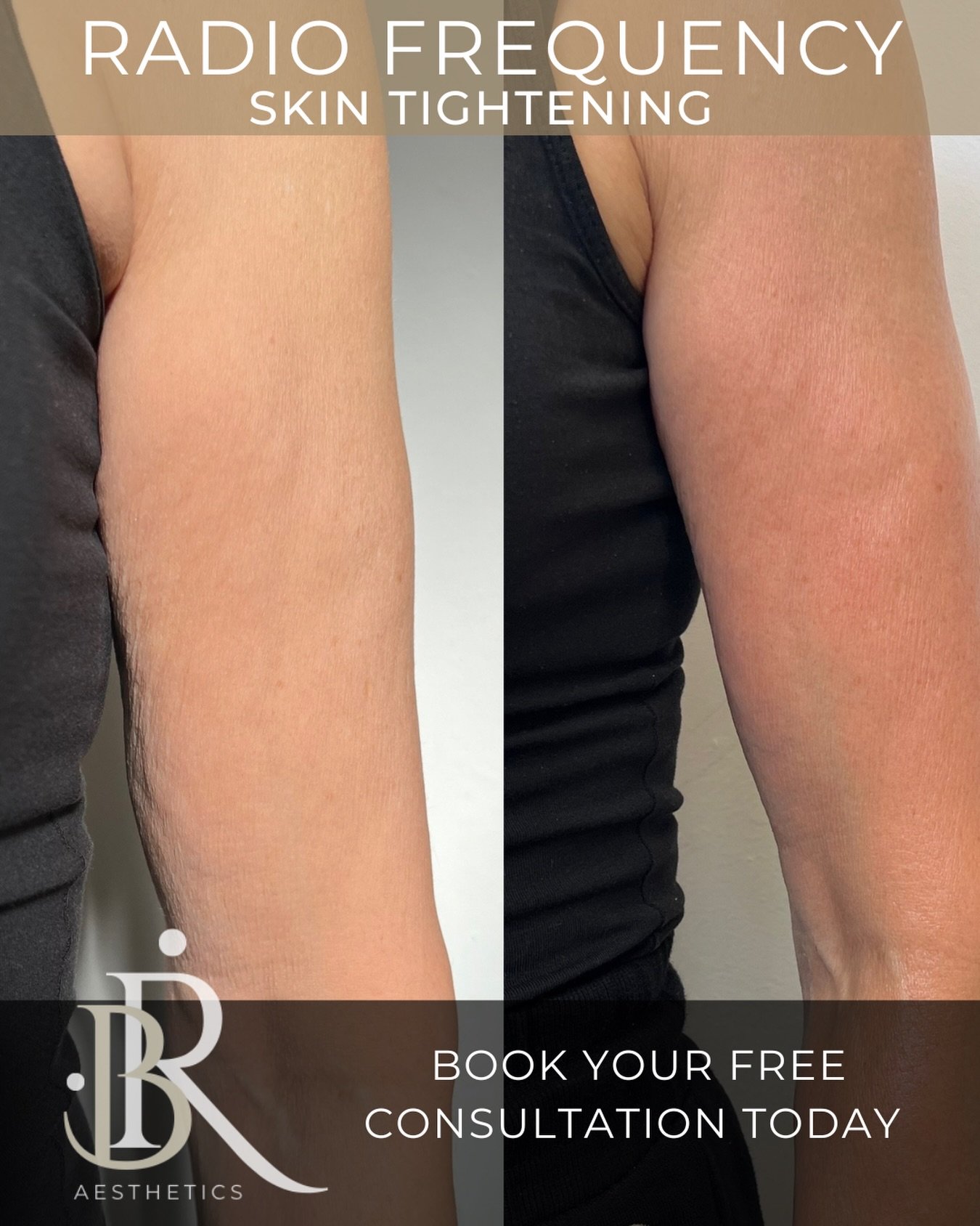 Radio frequency works by delivering controlled heat into the dermis to stimulate collagen production &mdash; helping to improve skin firmness and texture over time.

✨ 30 minute appointment
✨ Non-invasive
✨ No downtime

For best results, we recommend