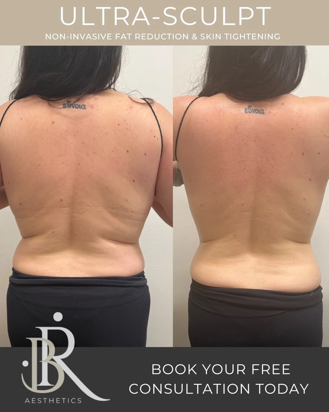 Let&rsquo;s talk about that area&hellip;

The one that feels impossible.
The bra-line bulge.
The back rolls that don&rsquo;t budge no matter how clean you eat or how hard you train.

You&rsquo;re not lazy.
You&rsquo;re not doing it wrong.
Some areas 