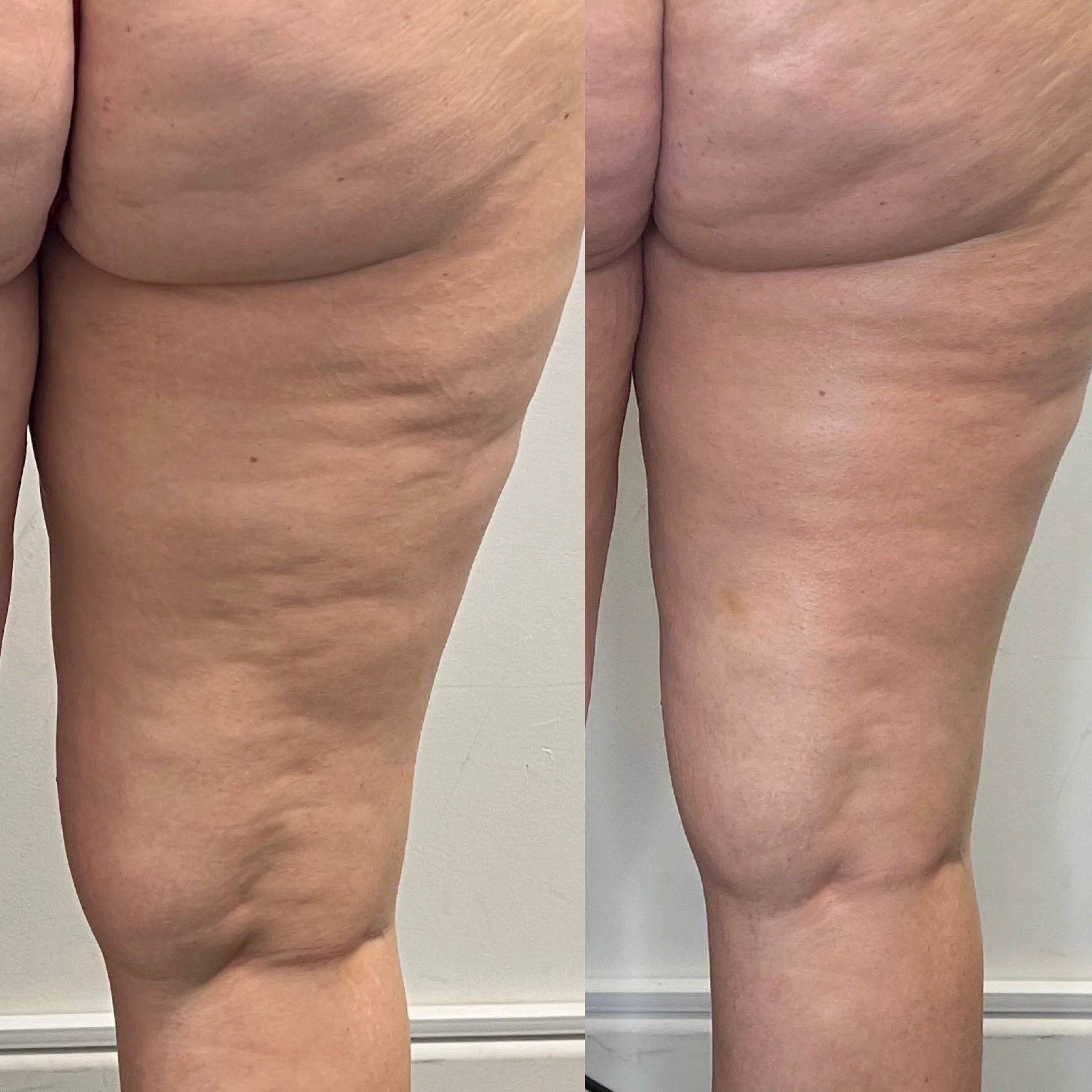 Before and after comparison of a person's thigh showing reduction in skin sagging and cellulite.