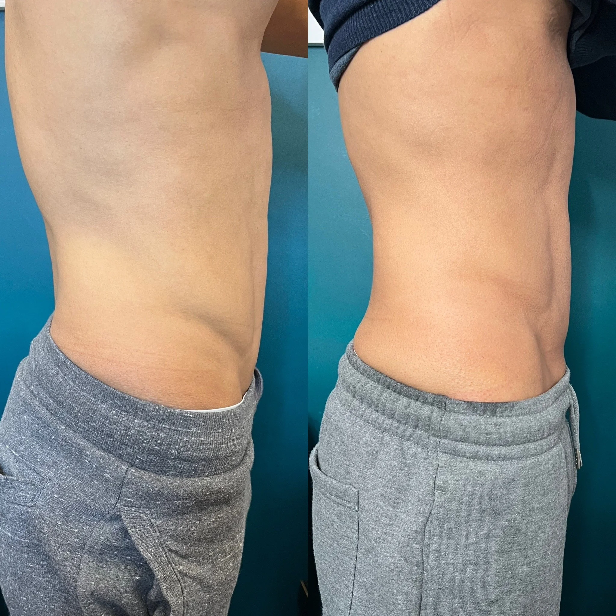 Body contouring for men in Leeds