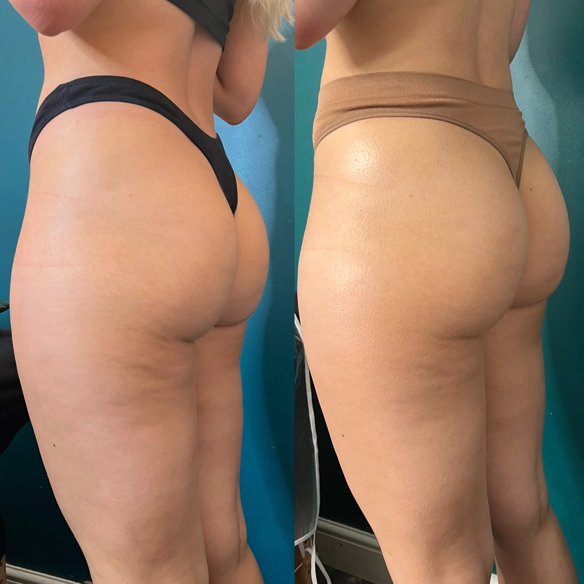 Non invasive booty lift treatment Leeds