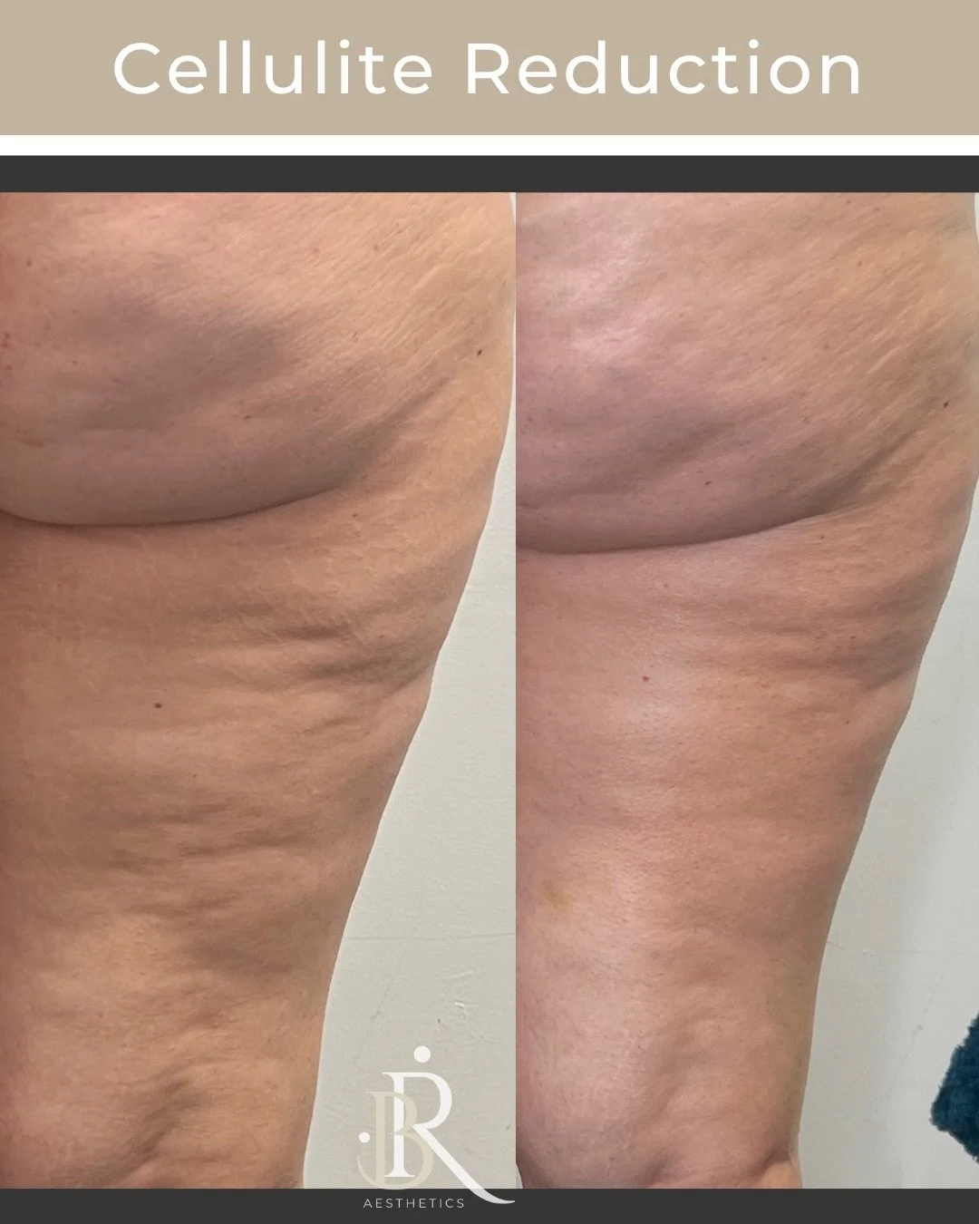 Cellulite reduction before after