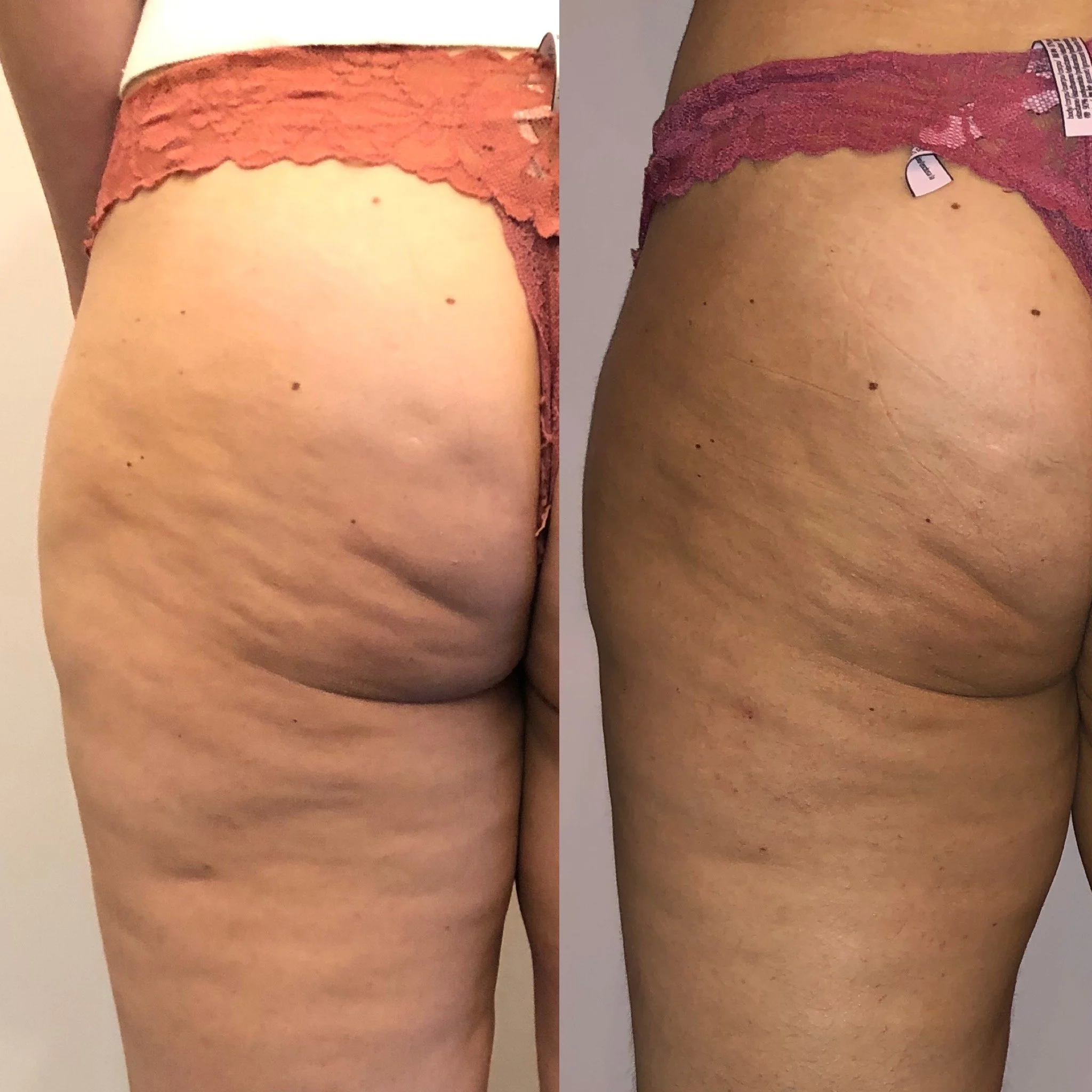 Cellulite reduction treatment in Leeds