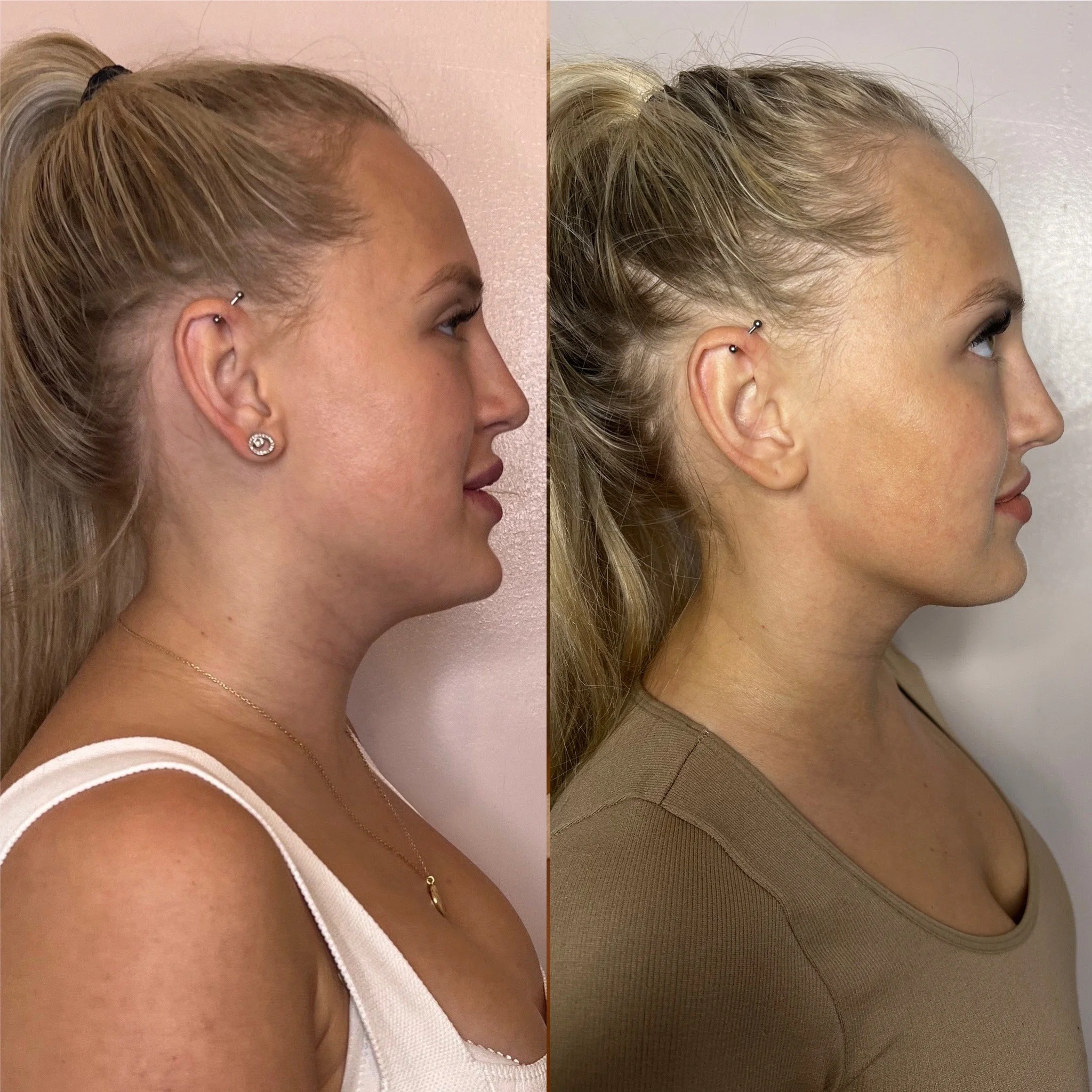 Chin and jaw sculpt treatment
