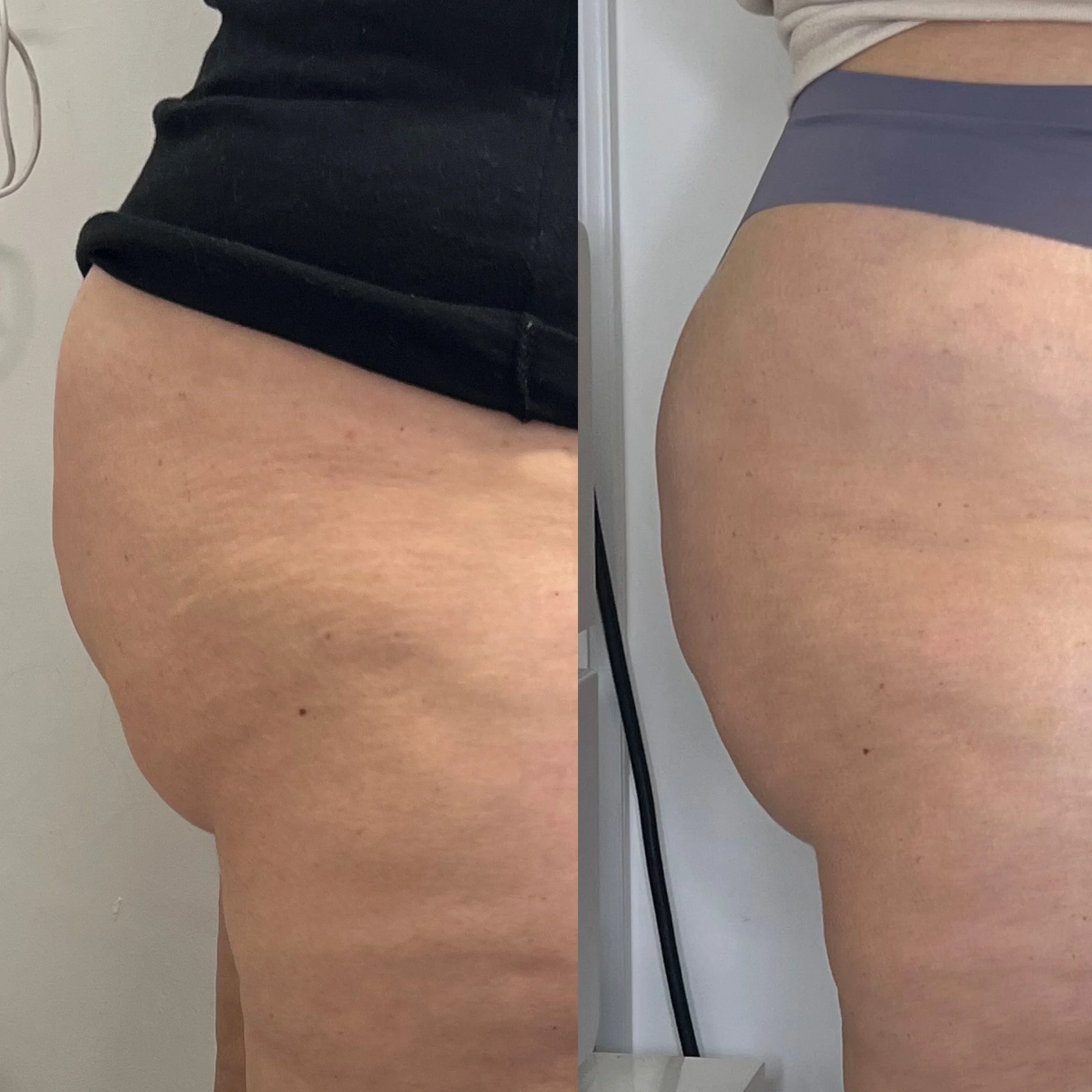 Side-by-side comparison of a woman's buttocks before and after skin treatment, showing smoother skin in the after photo.