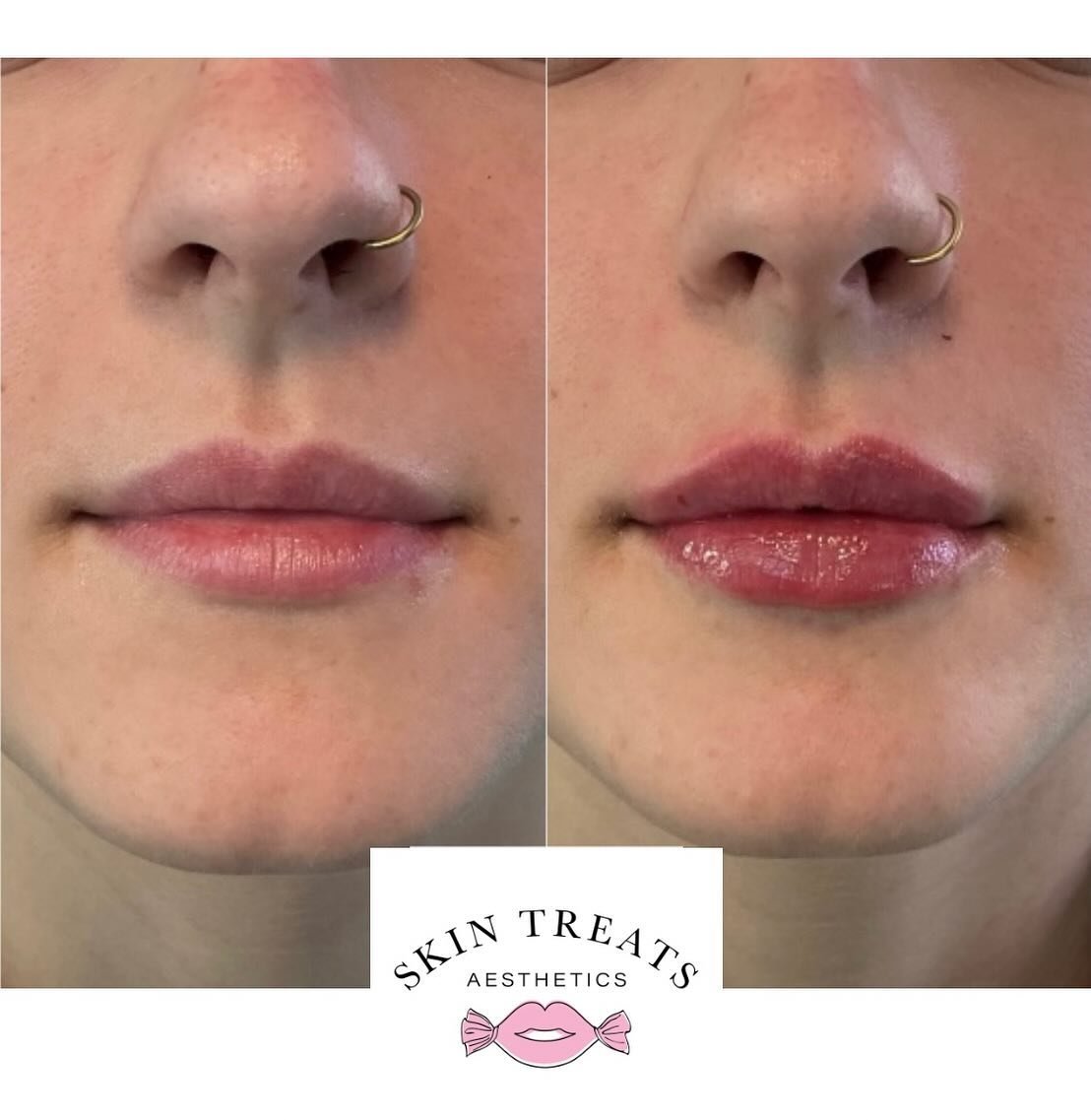 Considering treating yourself to lip filler? 

Here&rsquo;s what an appointment will look like. ✨

Consultation: We&rsquo;ll chat about your lip goals and desires. I&rsquo;ll craft a personalized plan just for you, ensuring we achieve the perfect loo
