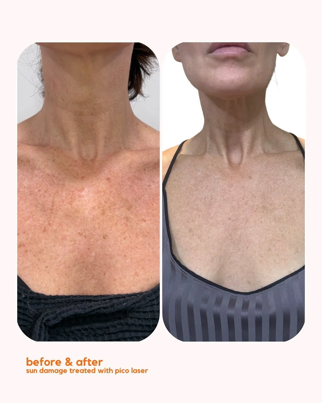 ☀️ Sun damage doesn&rsquo;t have to be permanent ☀️
Swipe through to see real results with the Pico Laser ➡️

✨ Targets stubborn brown spots + pigmentation
✨ Breaks up sun damage at its root
✨ Restores brighter, healthier-looking skin

These before +