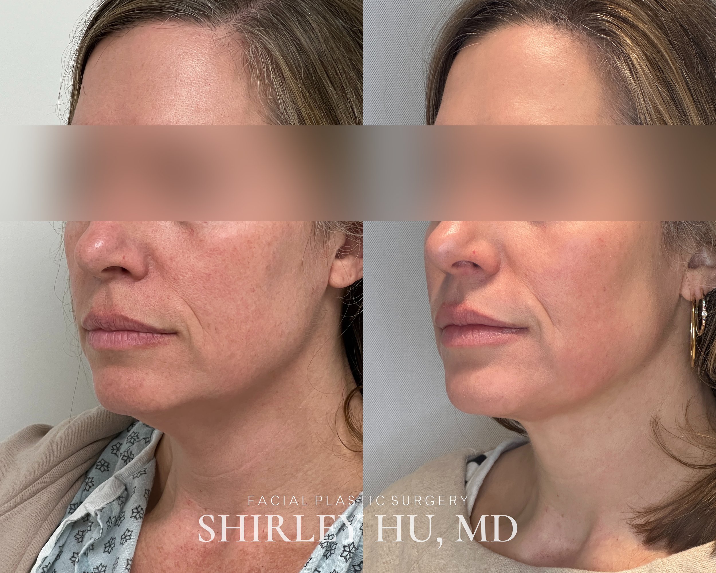 Deep neck lift, liposuction, and Renuvion neck skin tightening in a 46-year-old woman