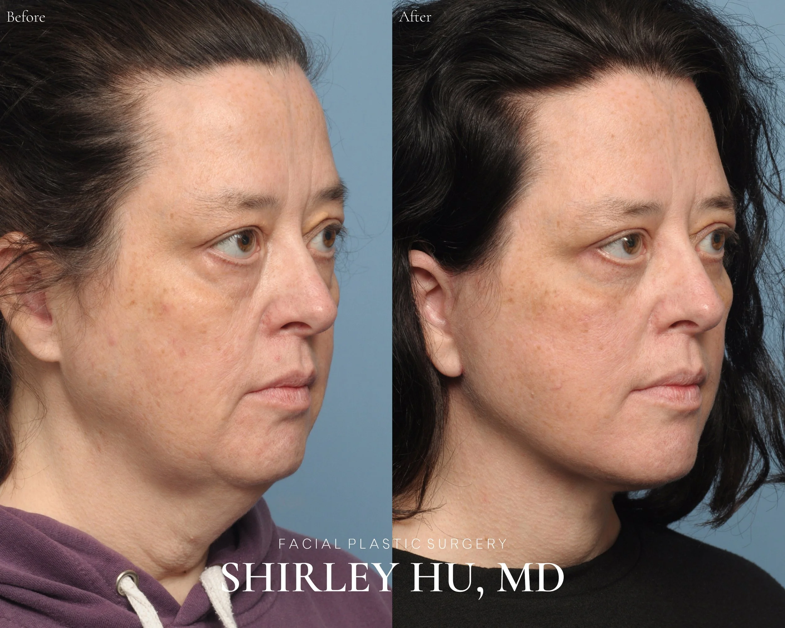 Upper and lower blepharoplasty, facelift, and neck lift in a 54-year-old woman
