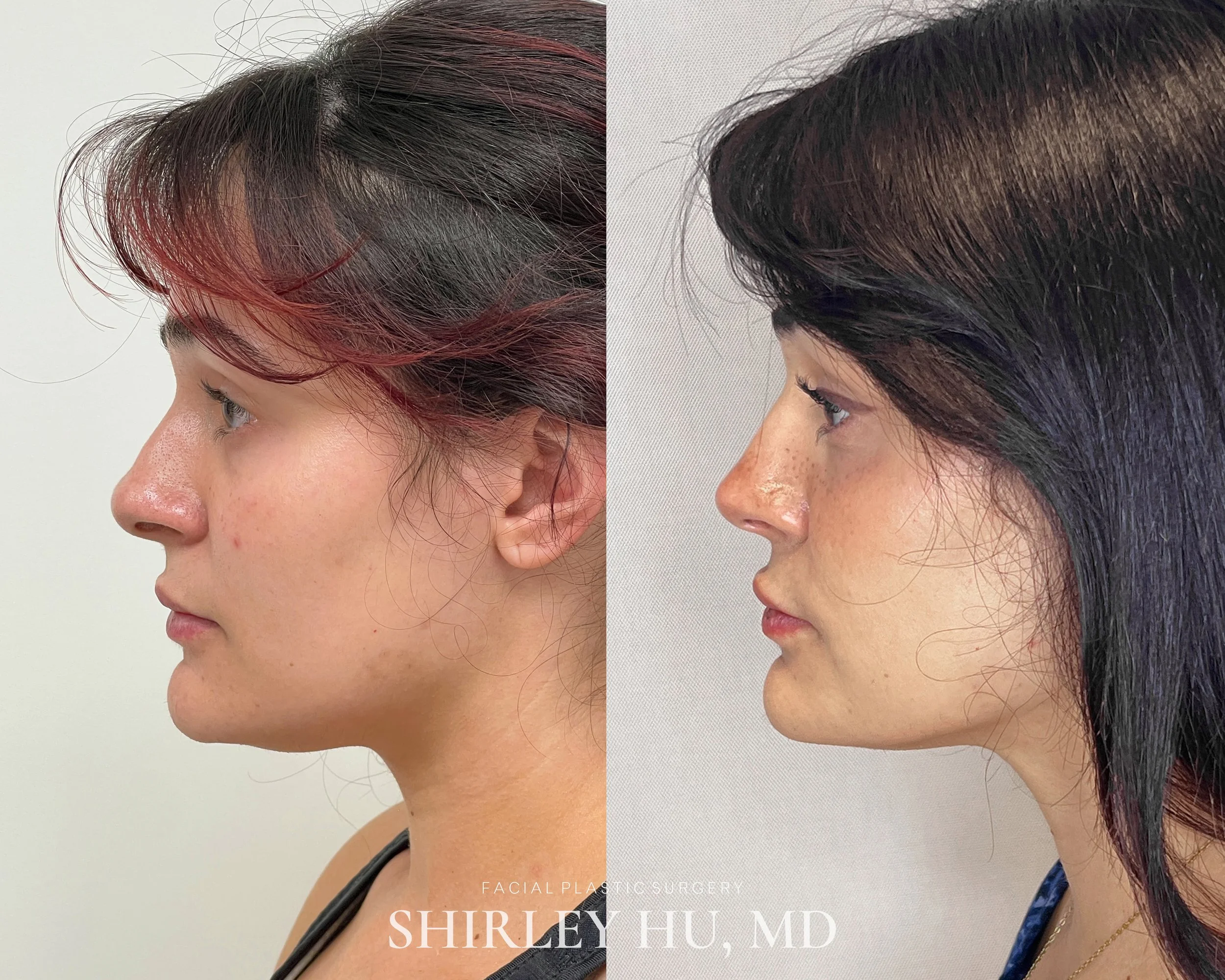 Primary rhinoplasty in a 26-year-old woman