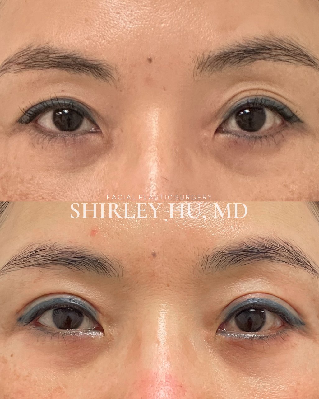 Upper blepharoplasty with crease formation and lower blepharoplasty in a 46-year-old woman