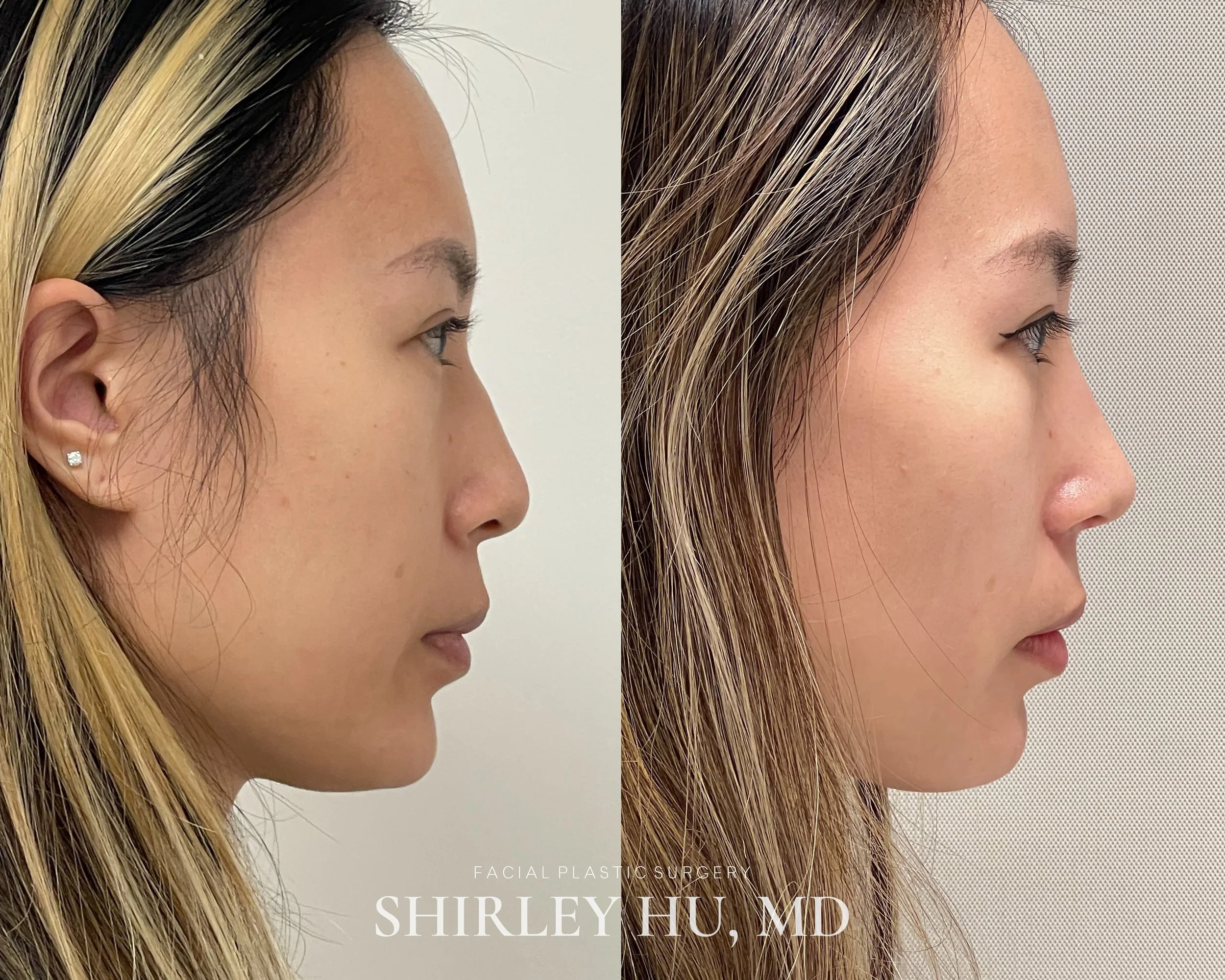 Primary rhinoplasty in a 26-year-old woman