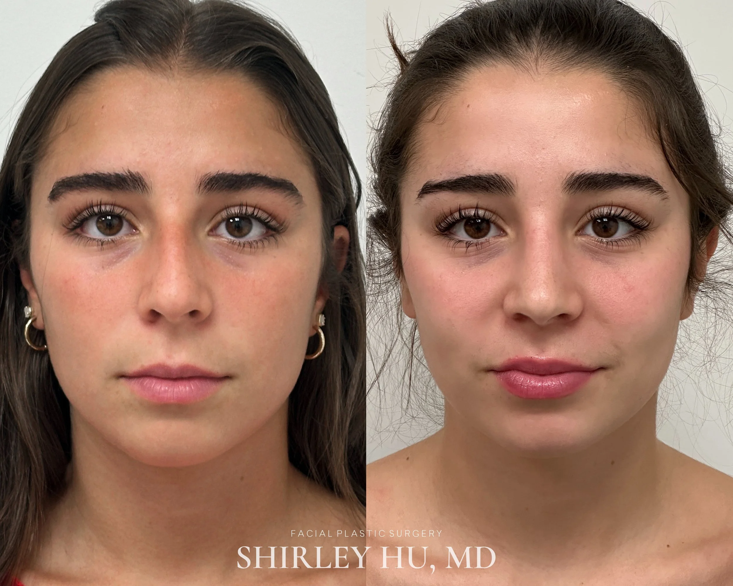 Primary rhinoplasty in a 17-year-old woman