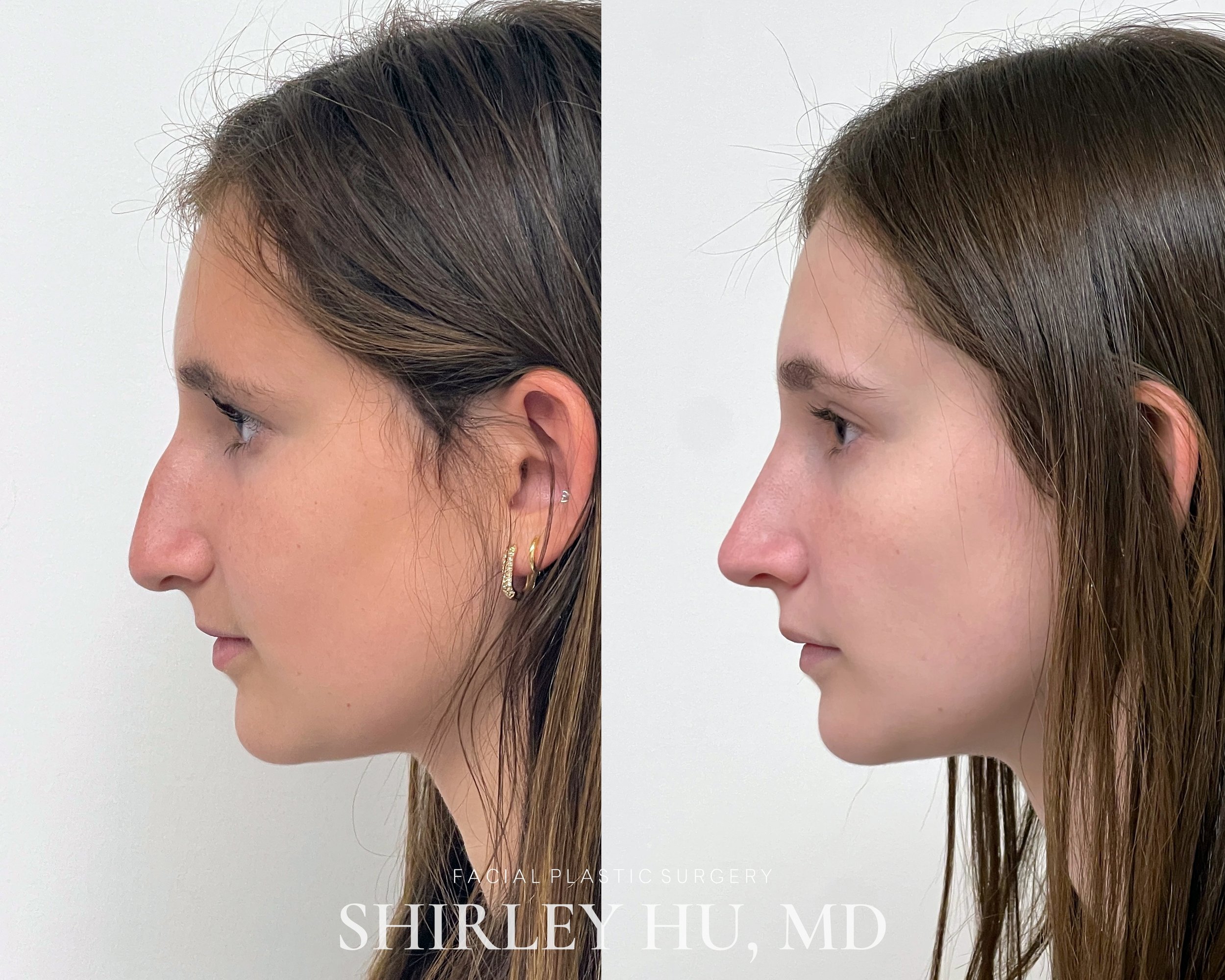 Primary rhinoplasty in a 15-year-old female