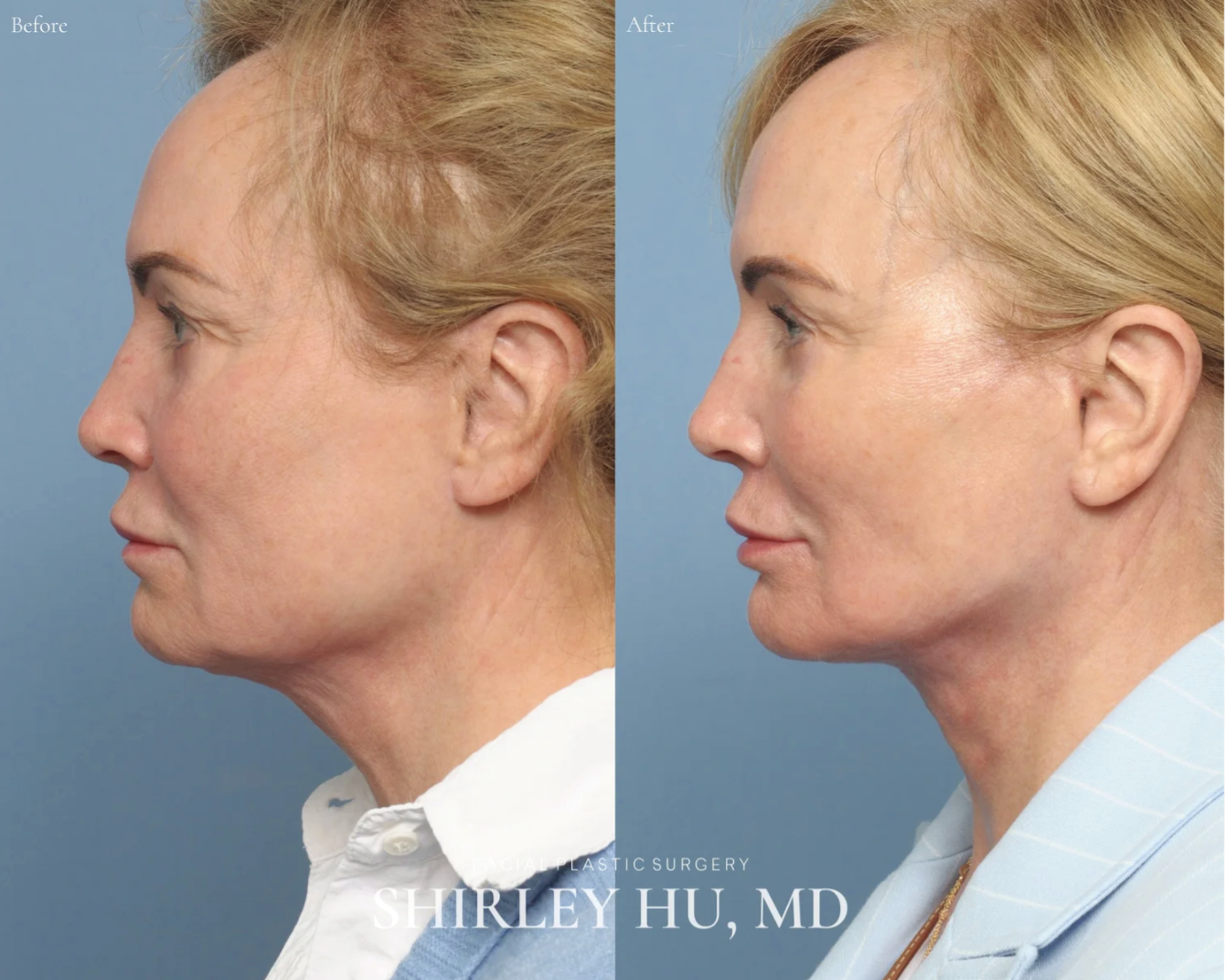 Secondary facelift, neck lift, and upper blepharoplasty in a 72-year-old woman
