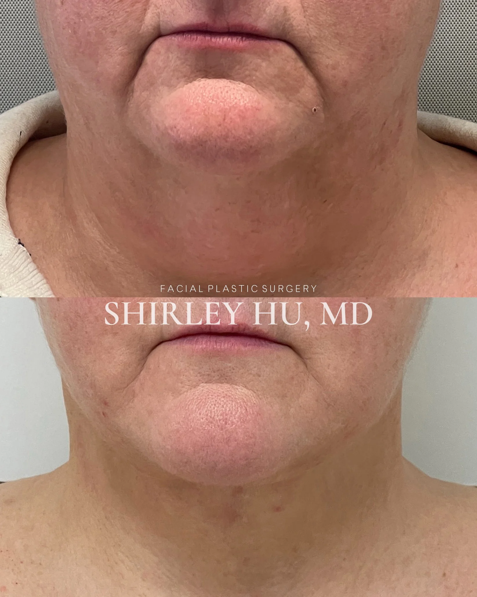 Extended deep plane face and neck lift in a 58-year-old woman