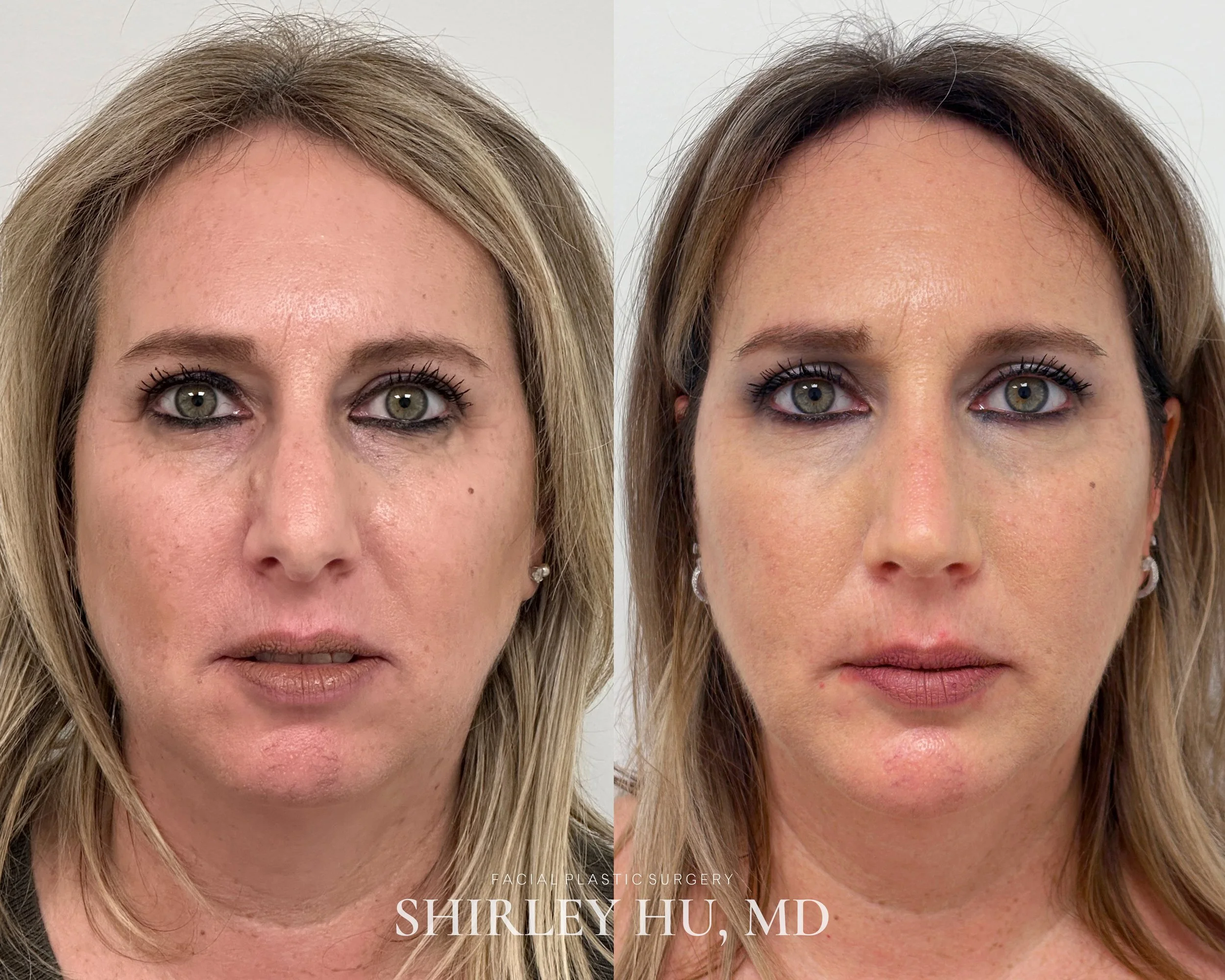 Rhinoplasty and chin implant in a 49-year-old woman