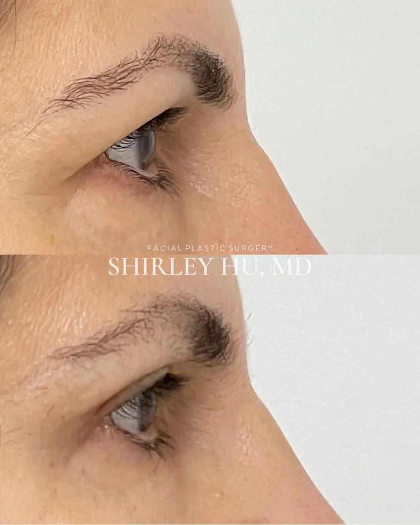 Upper and lower lid blepharoplasty in a 52-year-old woman