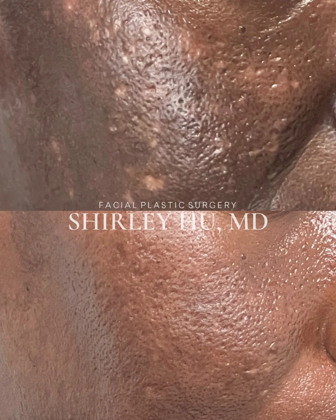 Nanofat and microfat grafting for hypopigmented scarring and acne scars
