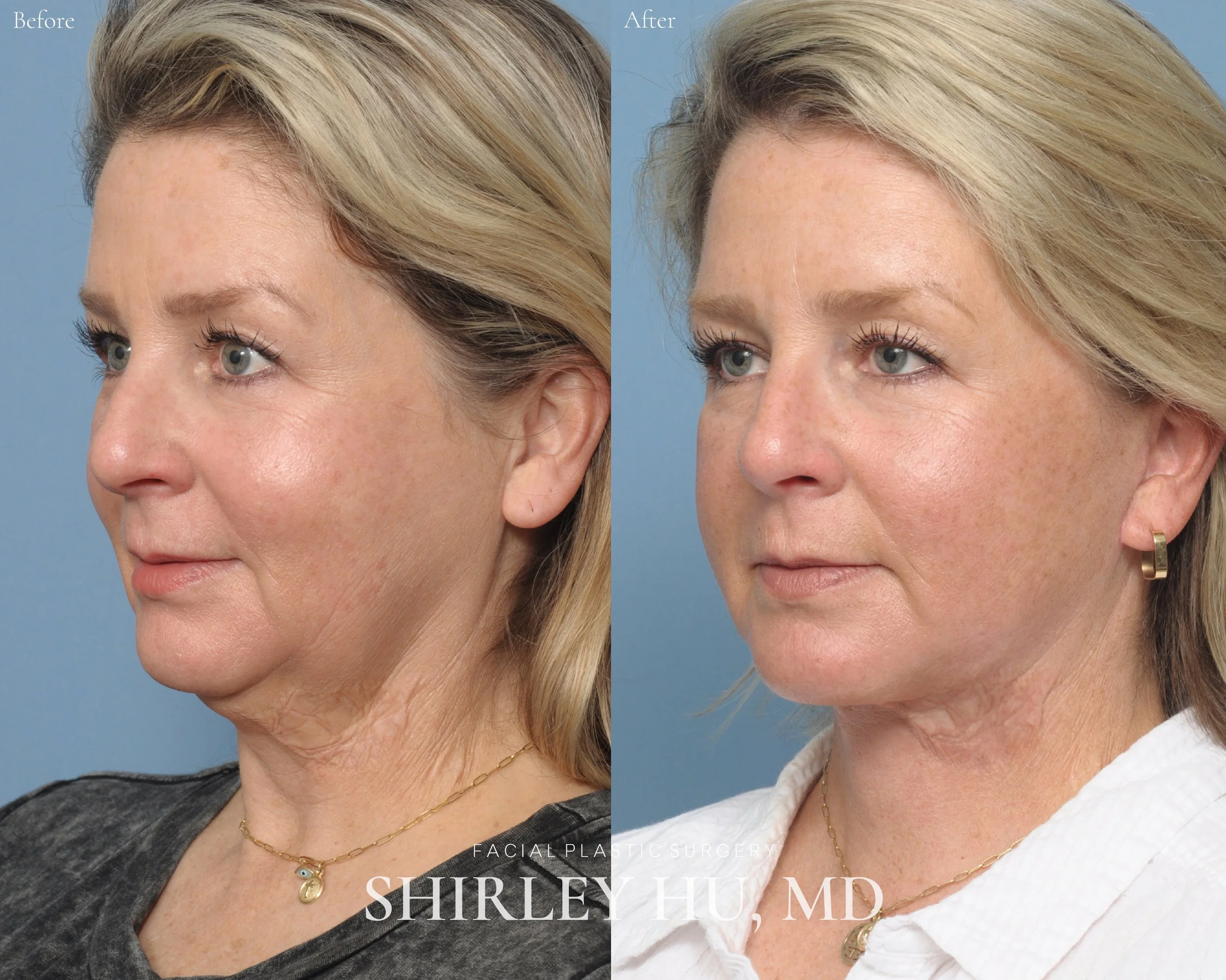 Extended deep plane face and neck lift in a 52-year-old woman