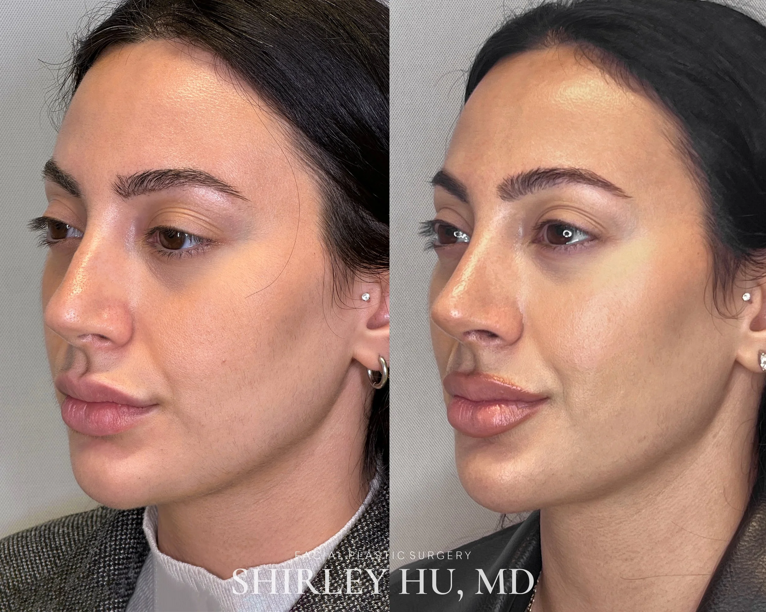 Primary rhinoplasty in a 28-year-old woman