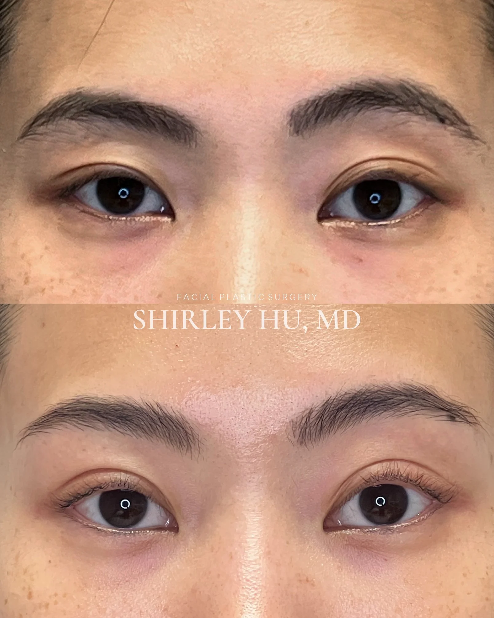 Endoscopic brow lift and upper blepharoplasty in a 31-year-old woman