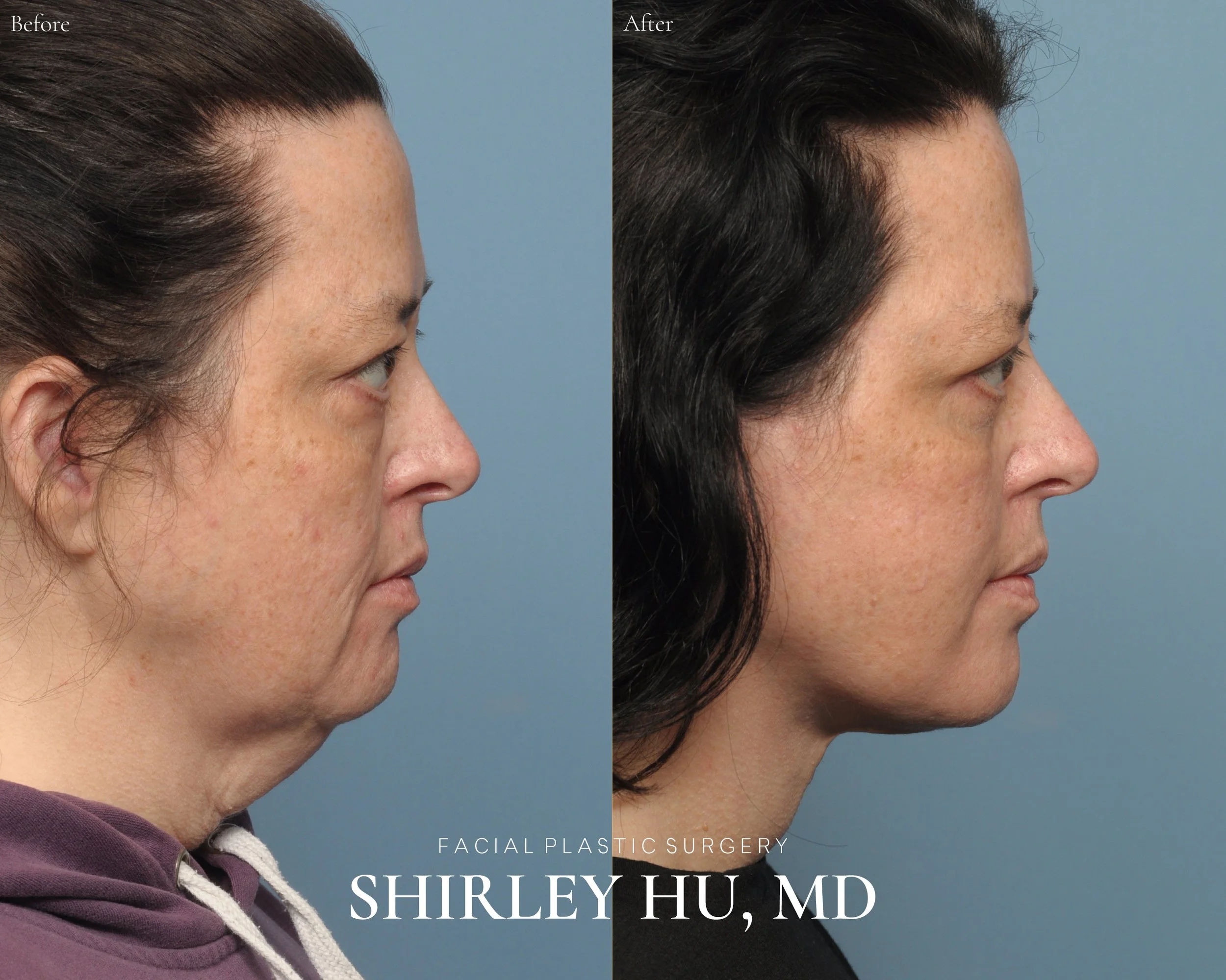 Upper and lower blepharoplasty, facelift, and neck lift in a 54-year-old woman