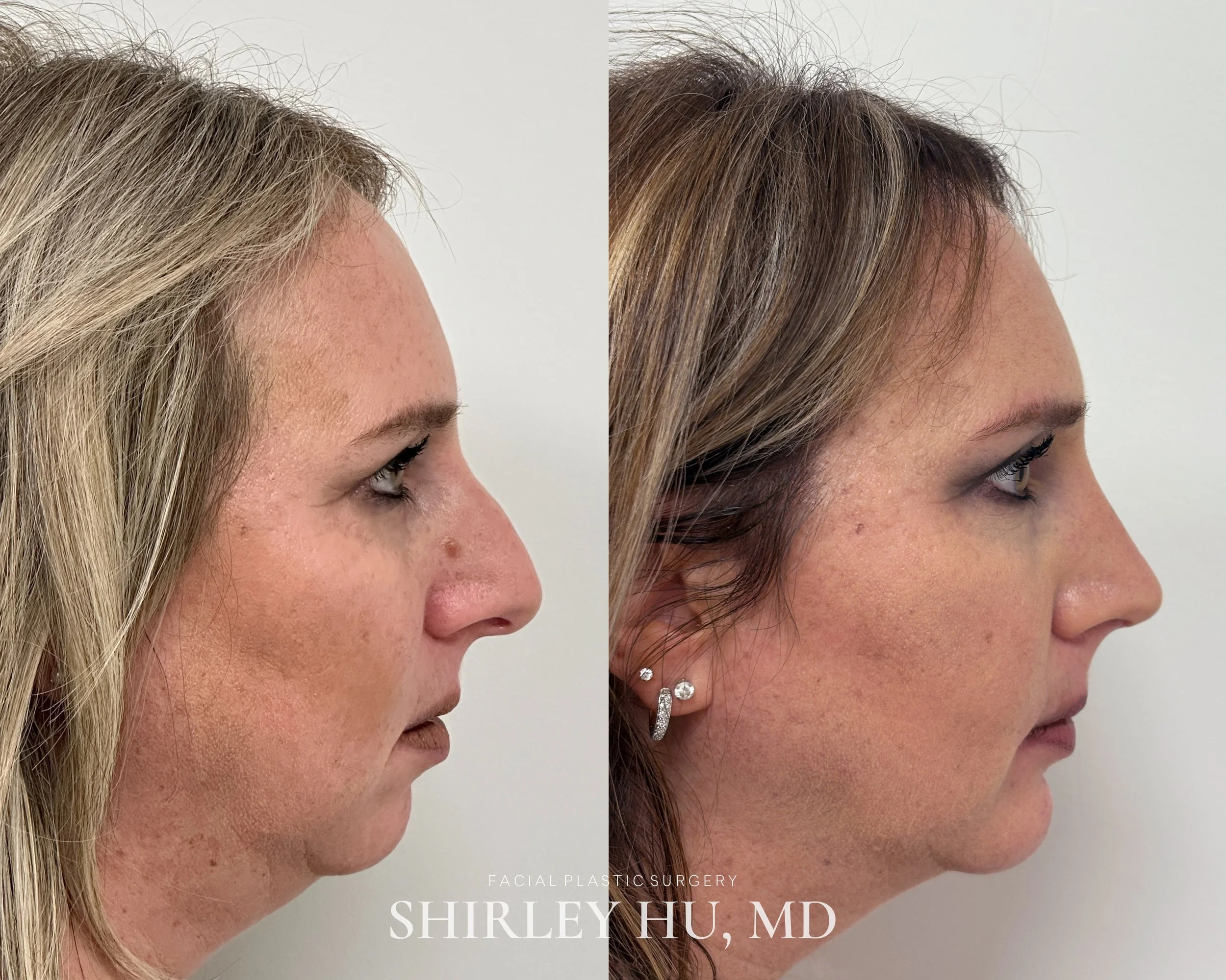 Rhinoplasty and chin implant in a 49-year-old woman