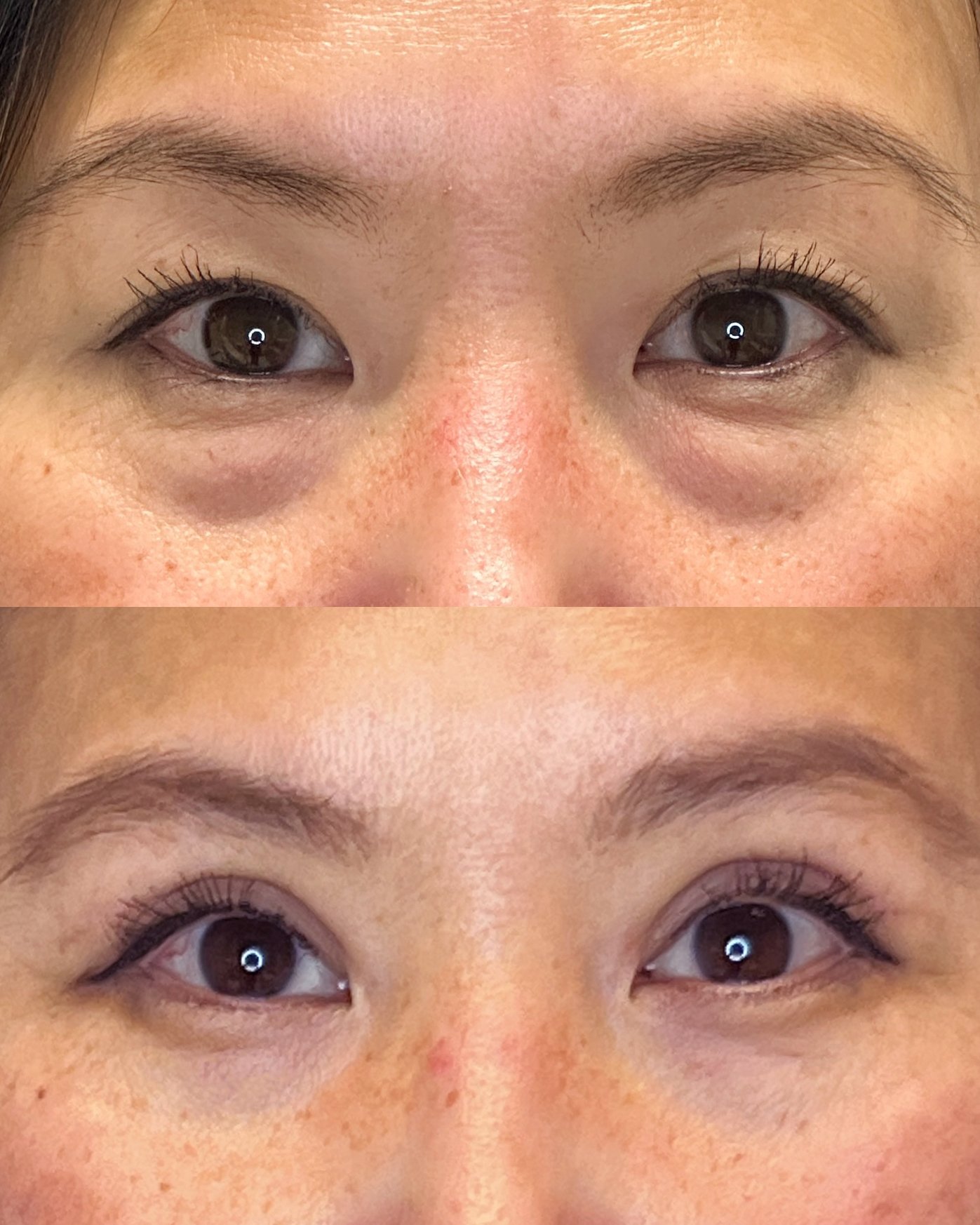 Upper blepharoplasty with crease formation and lower blepharoplasty in a 48-year-old woman