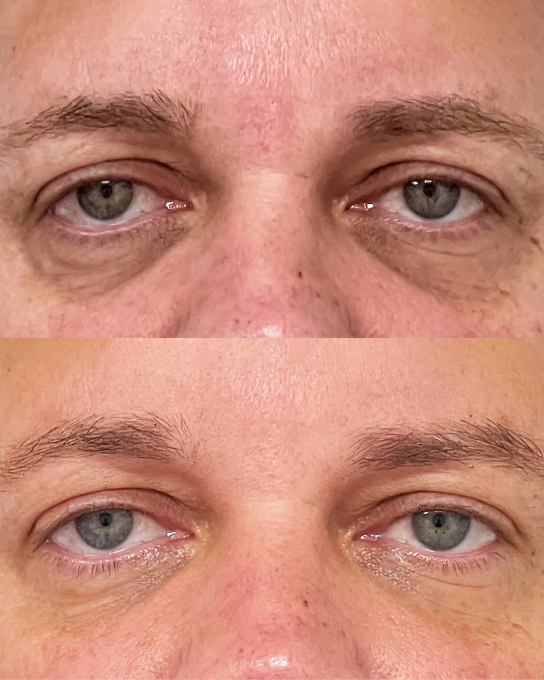 Microfat grafting to lower eyelids
