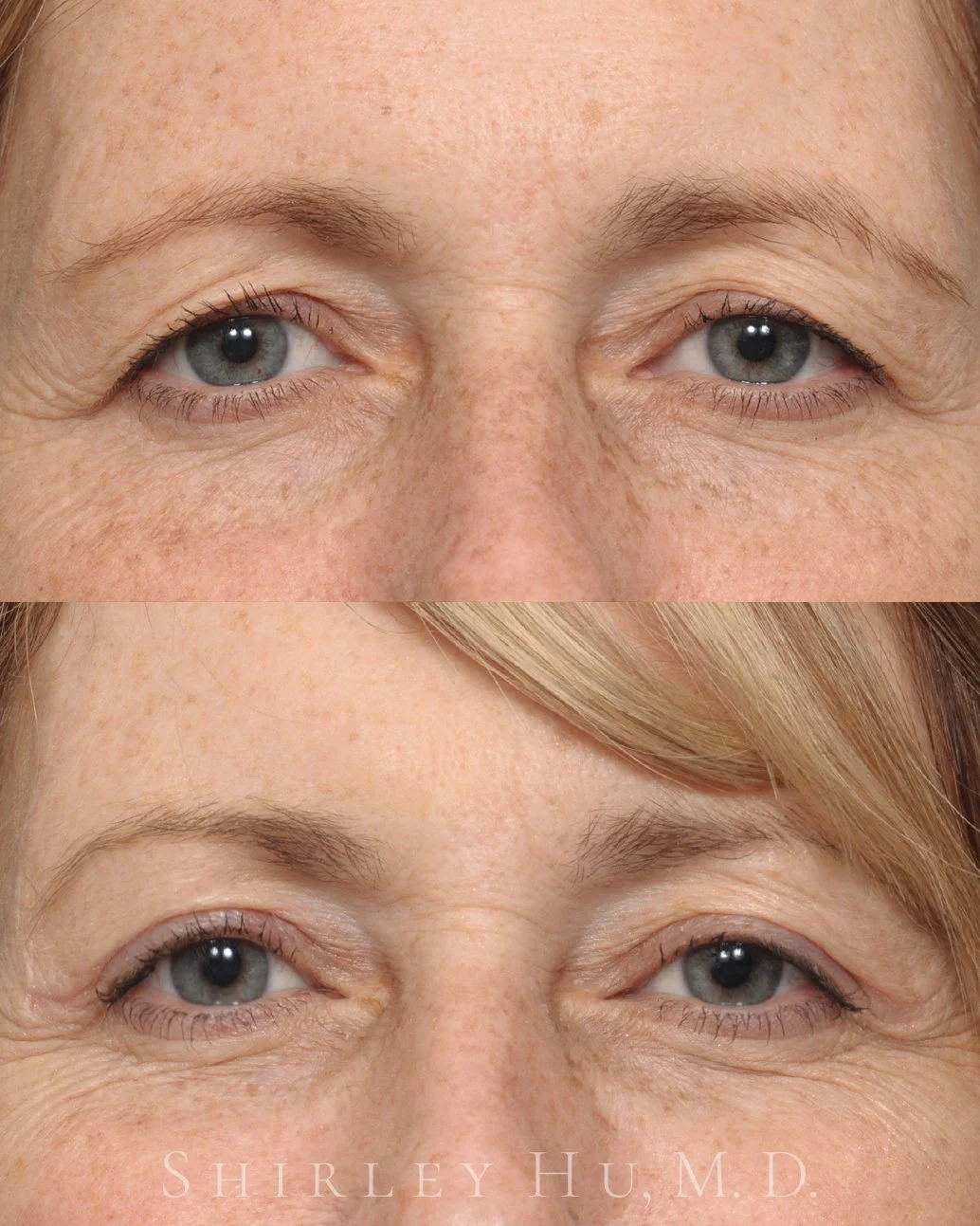 Upper lid blepharoplasty and endoscopic brow lift in a 56-year-old woman