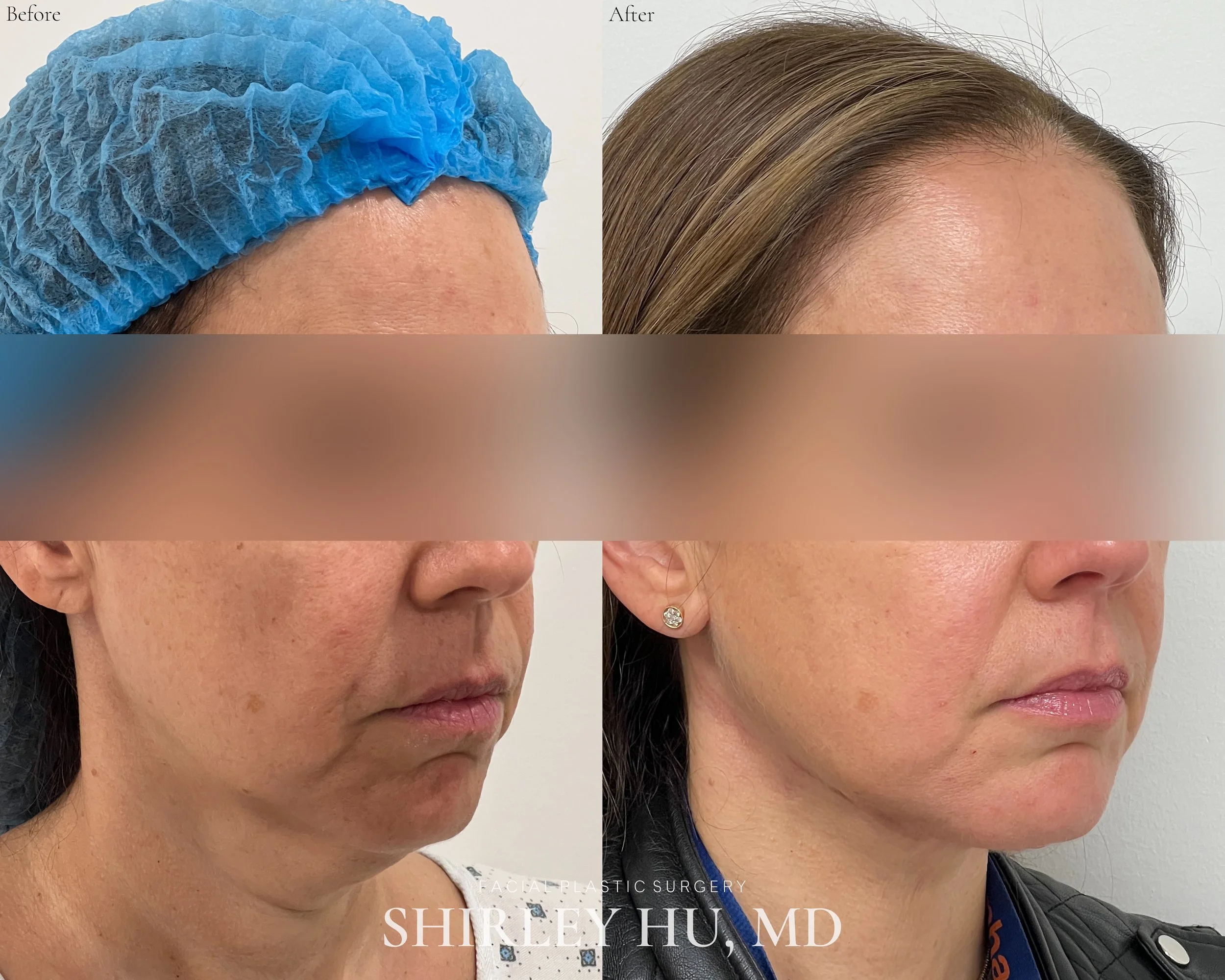 Extended neck lift in a 46-year-old woman 
