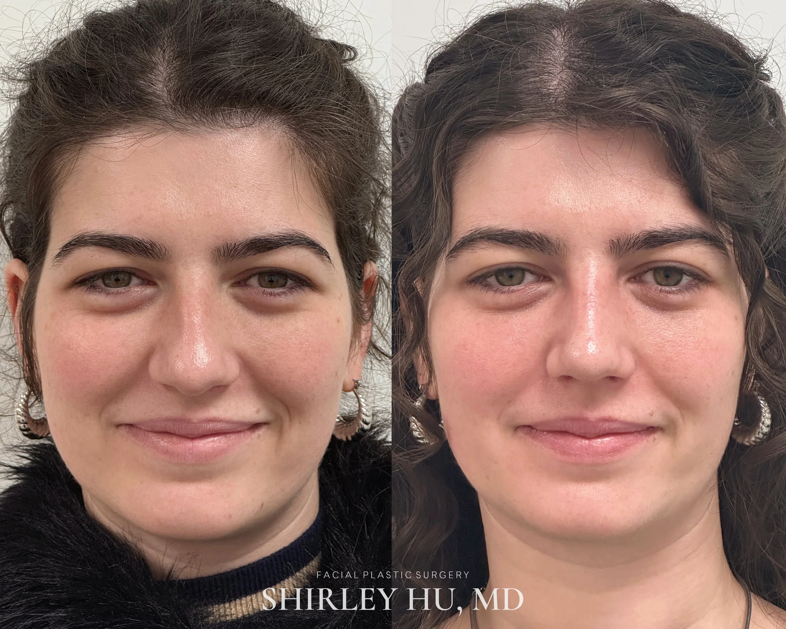 Primary rhinoplasty in a 29-year-old woman