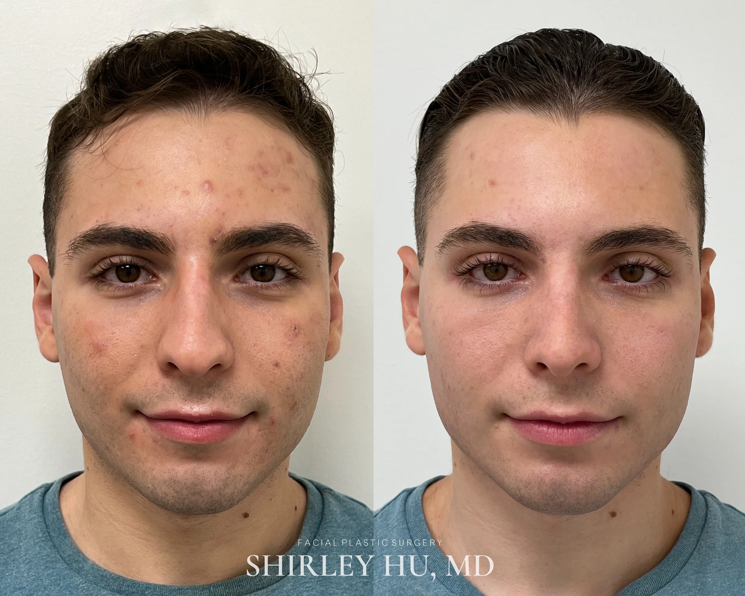 Primary rhinoplasty in a 20-year-old male