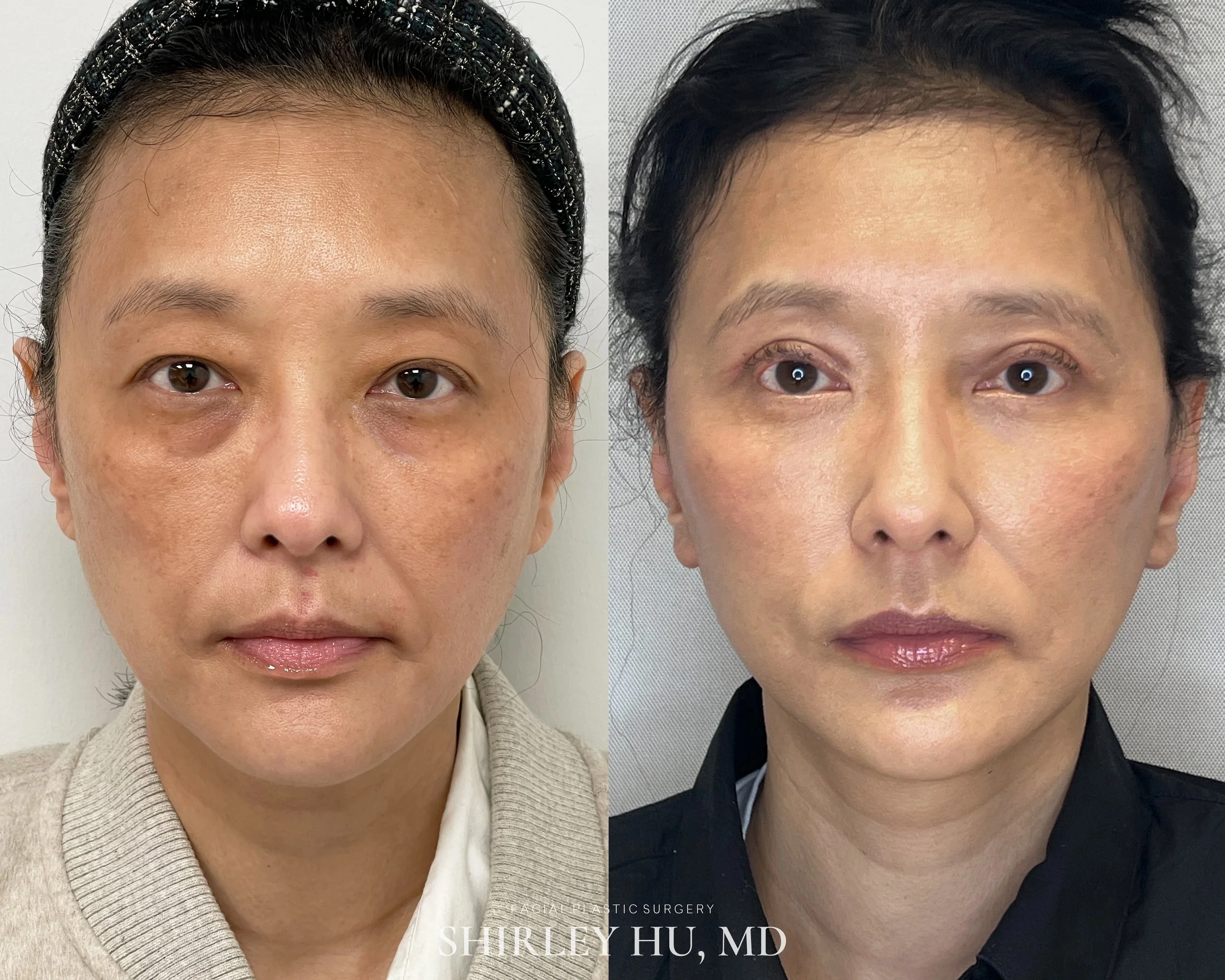Facelift, neck lift, upper blepharoplasty, and lower blepharoplasty in a 49-year-old woman