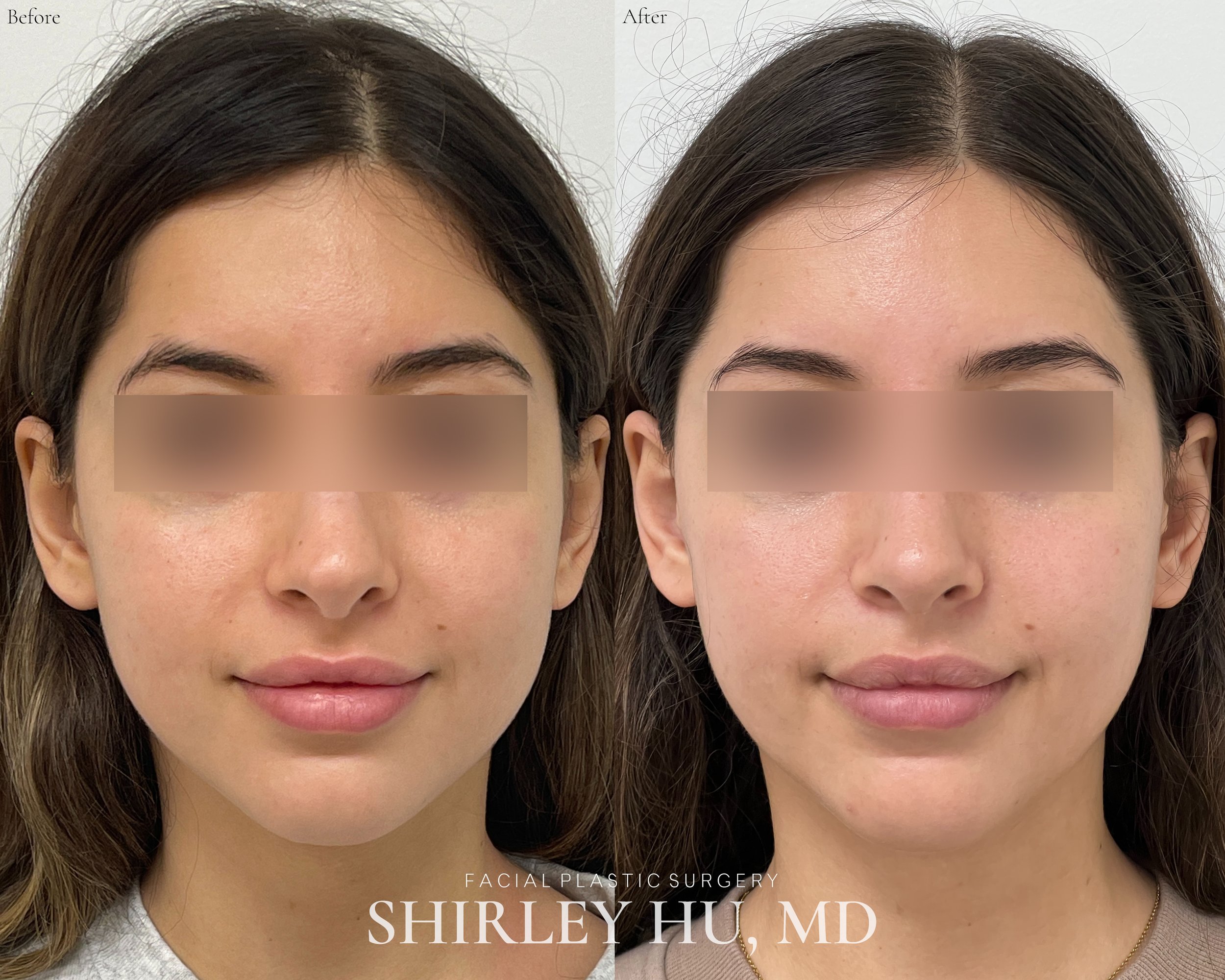 Revision rhinoplasty in a 25-year-old woman