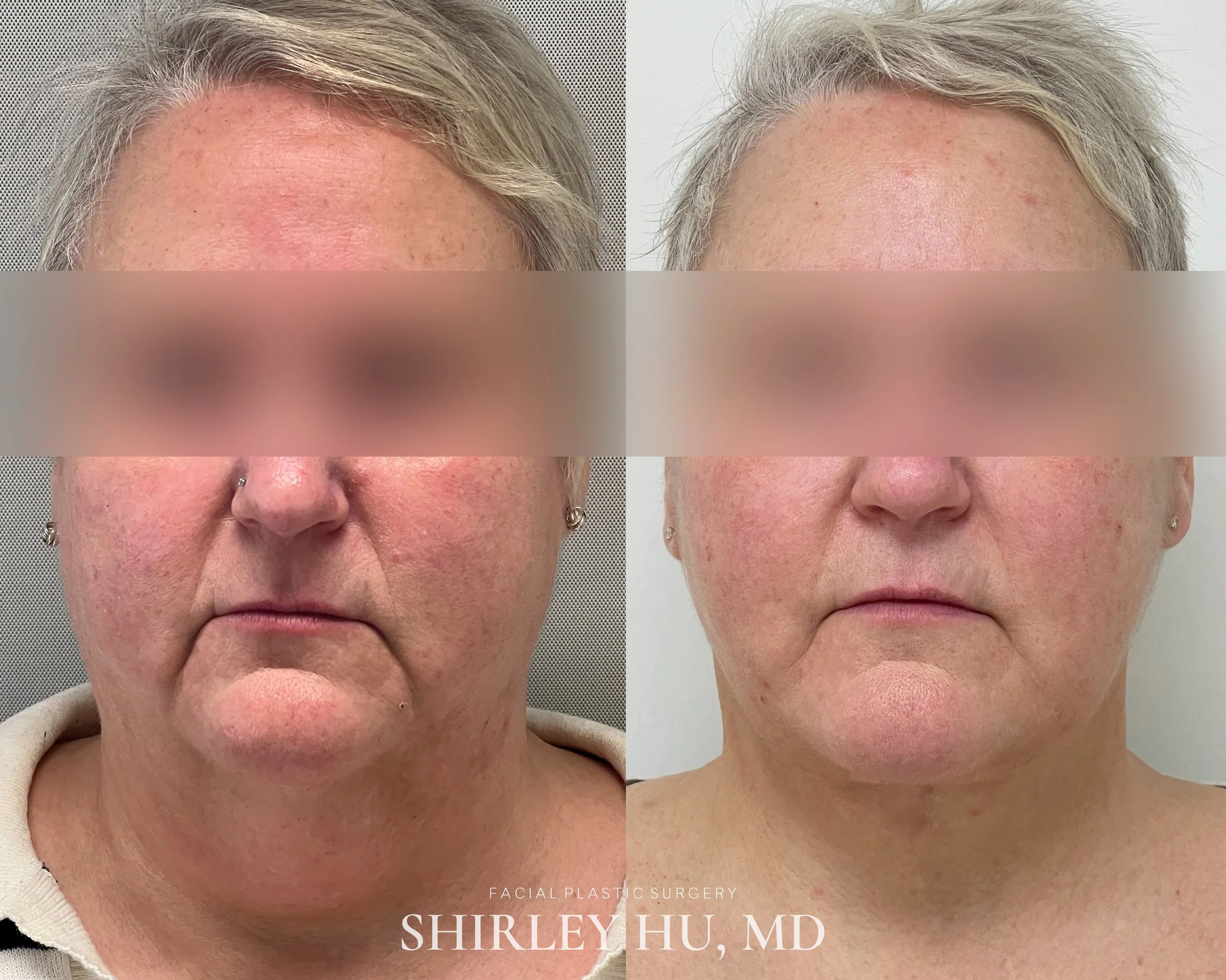Extended deep plane face and neck lift in a 55-year-old woman