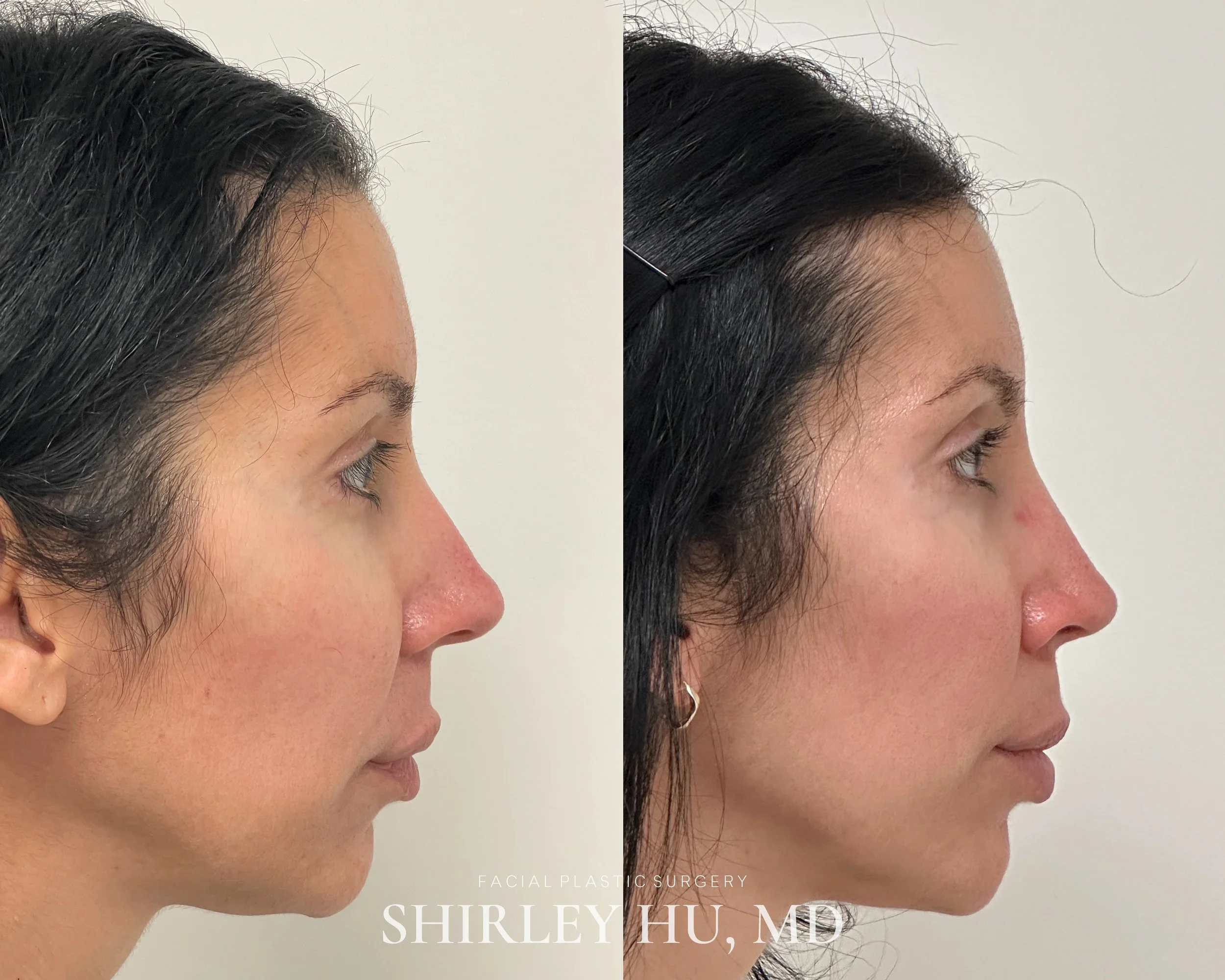 Primary rhinoplasty in a 42-year-old woman 