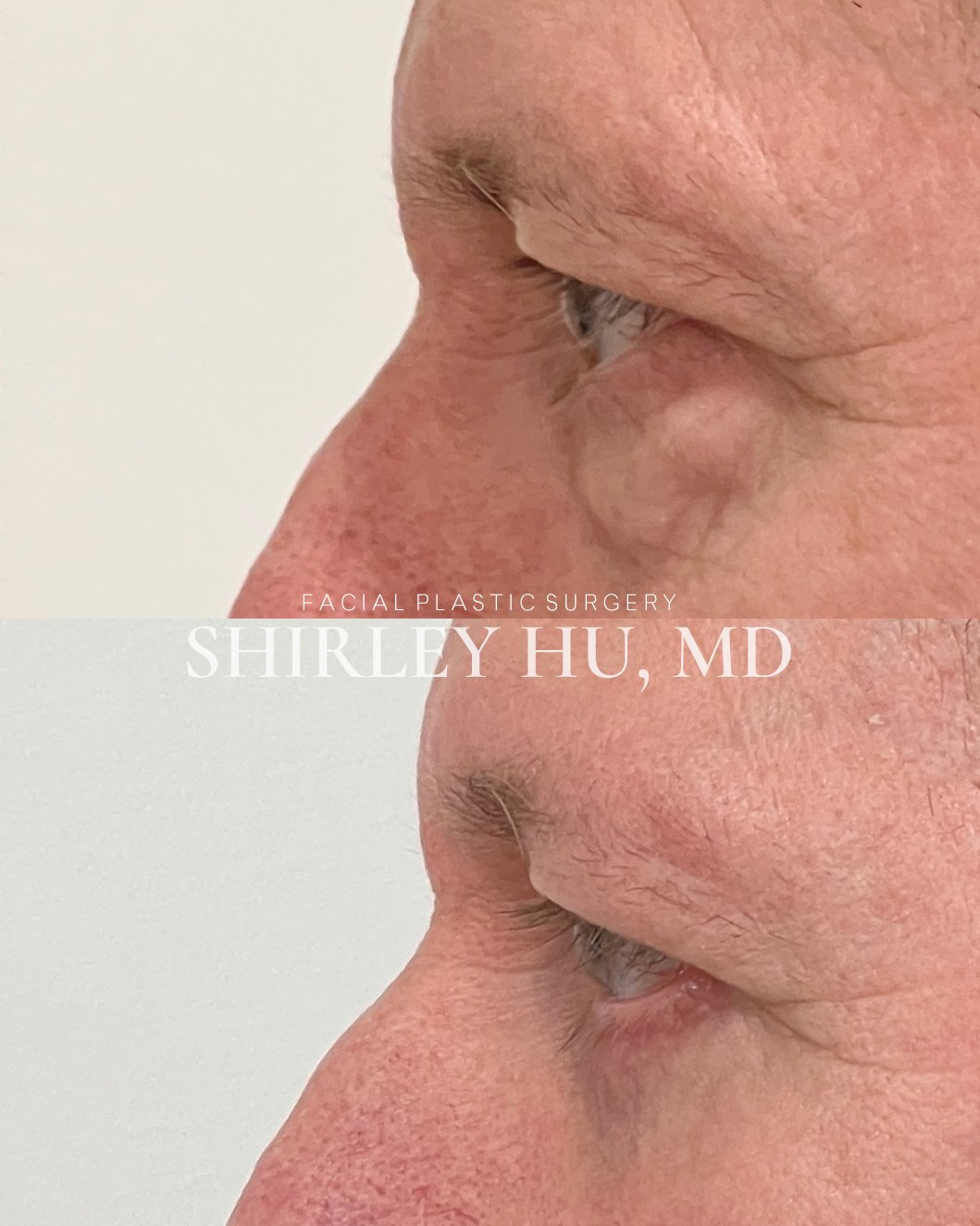 Lower blepharoplasty in a 63-year-old man