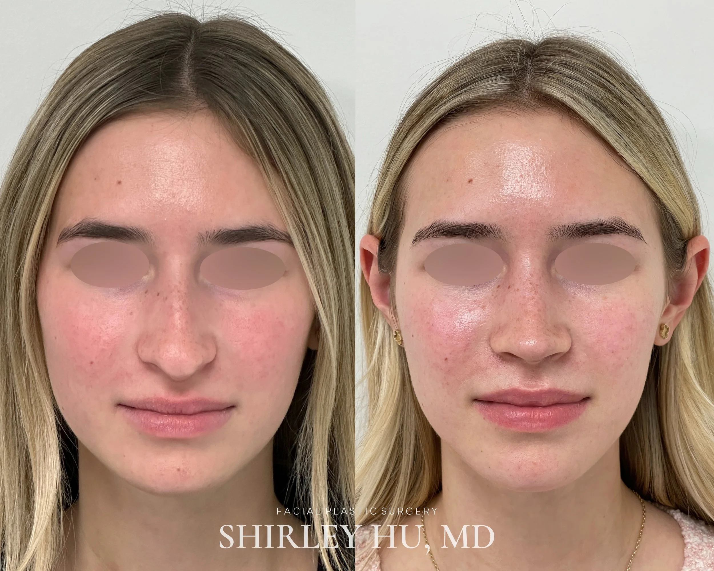 Primary rhinoplasty in a 20-year-old woman