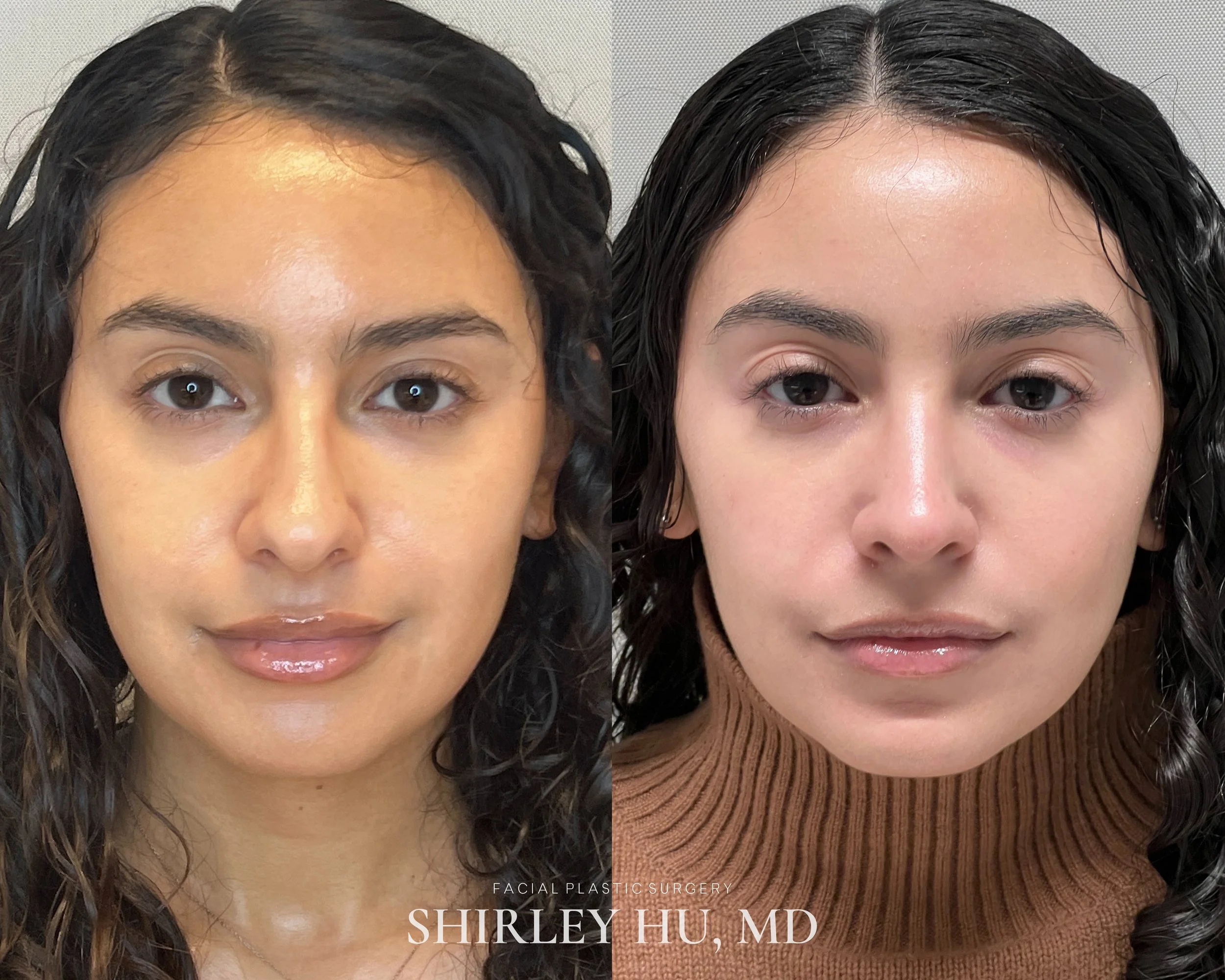 Primary rhinoplasty in a 30-year-old woman