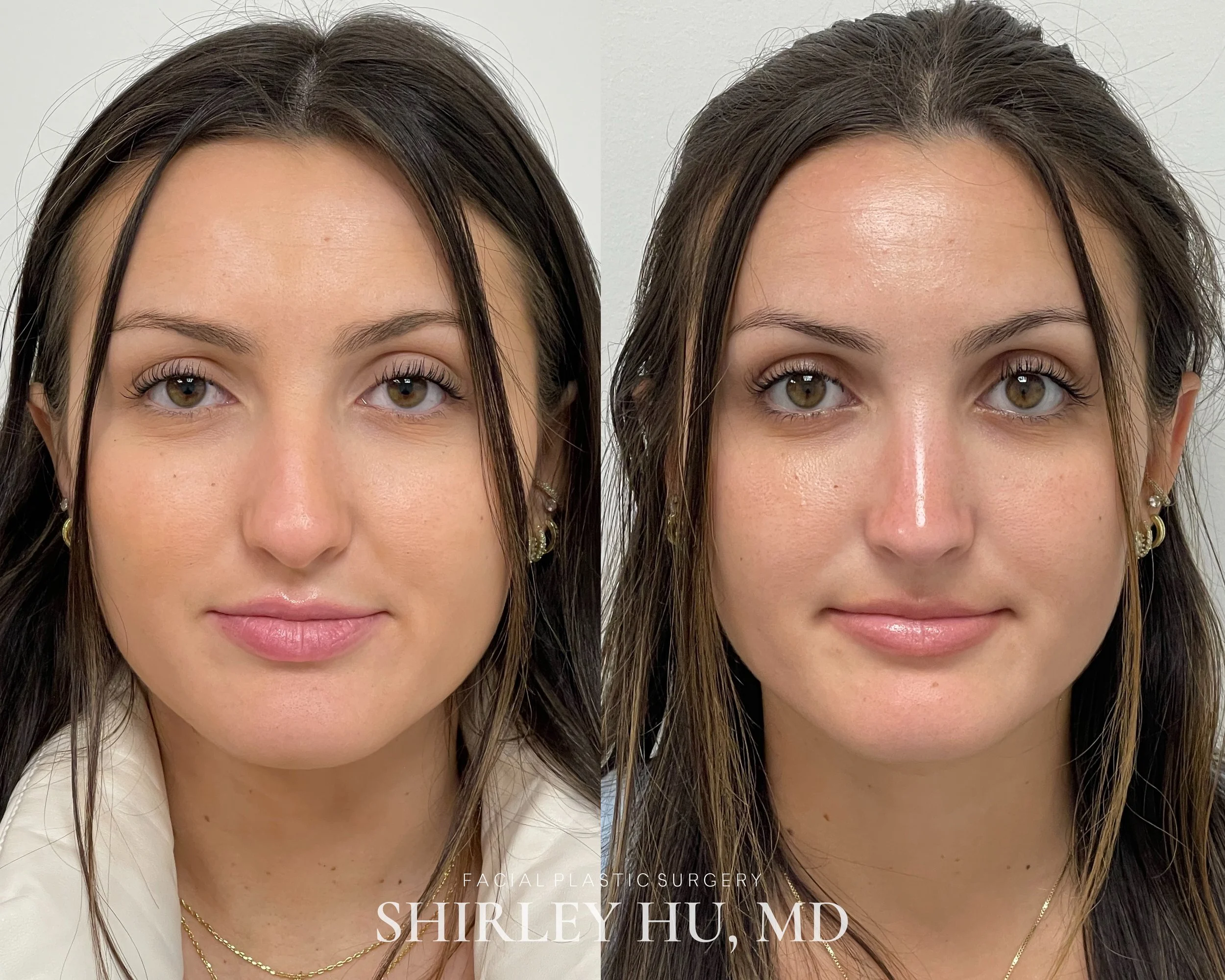 Primary rhinoplasty in a 22-year-old woman