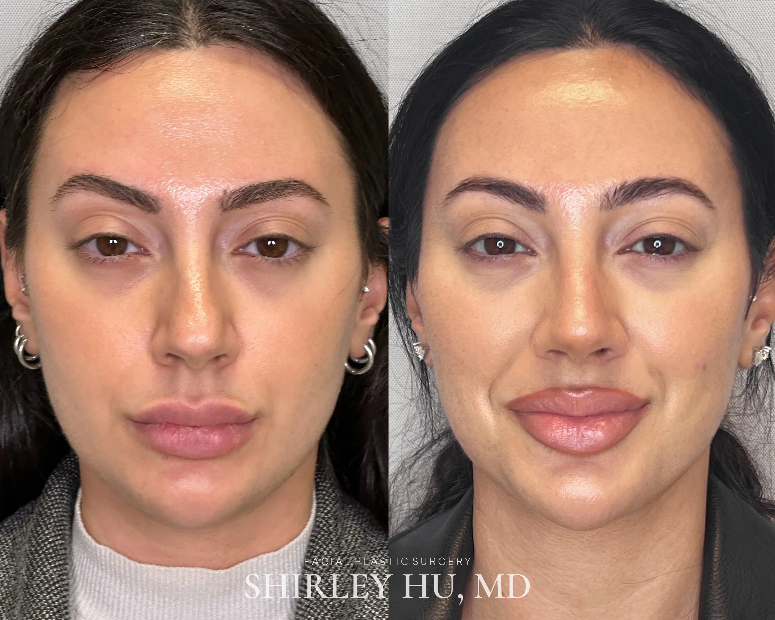 Primary rhinoplasty in a 28-year-old woman